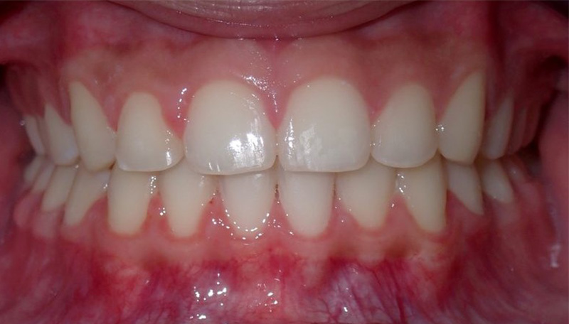 After orthodontic treatment