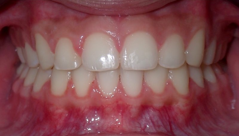 After orthodontic treatment
