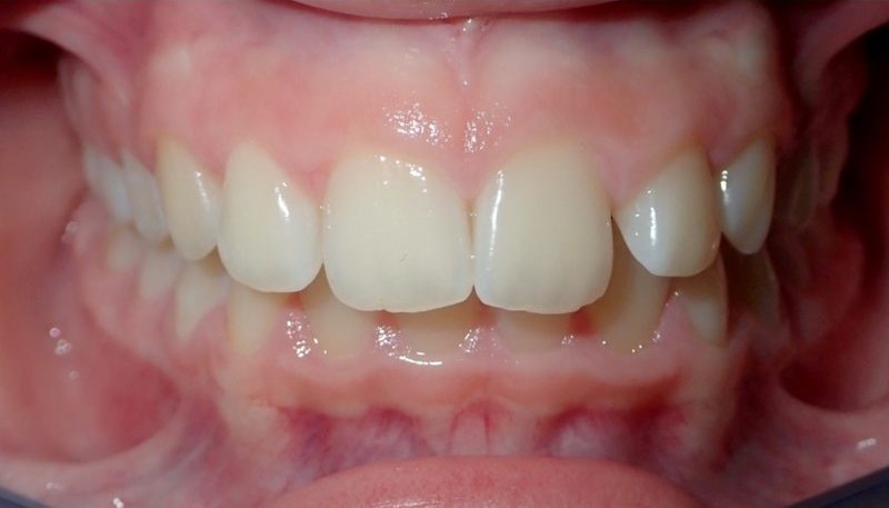 Before orthodontic treatment