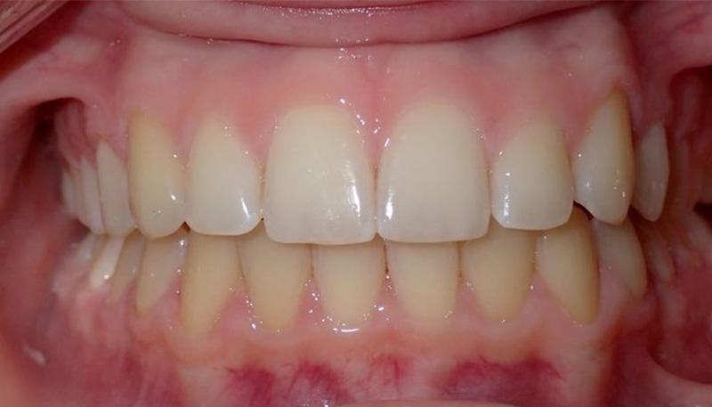 After orthodontic treatment