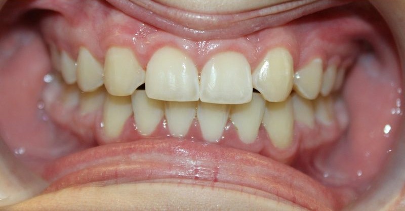 After orthodontic treatment