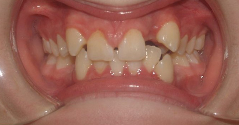 Before orthodontic treatment