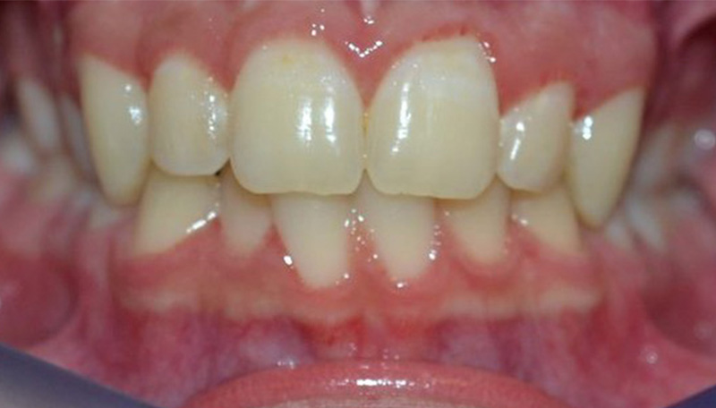 Before orthodontic treatment