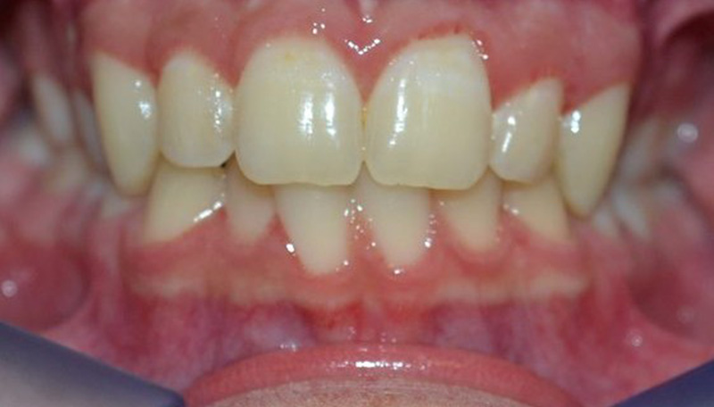 Before orthodontic treatment