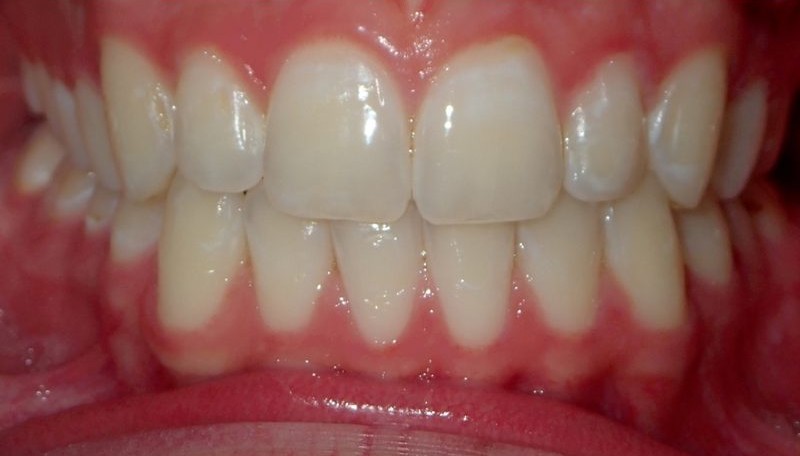 After orthodontic treatment
