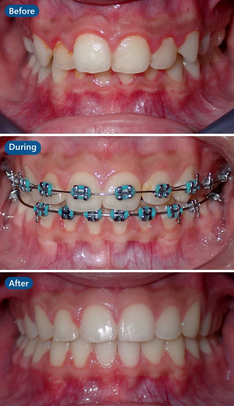 Before, during and after orthodontic treatment