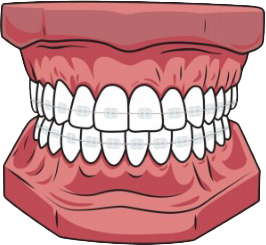 Clear braces