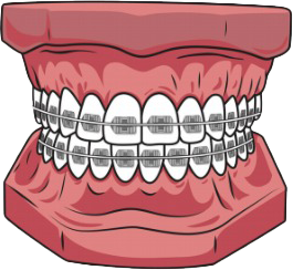 Premium braces