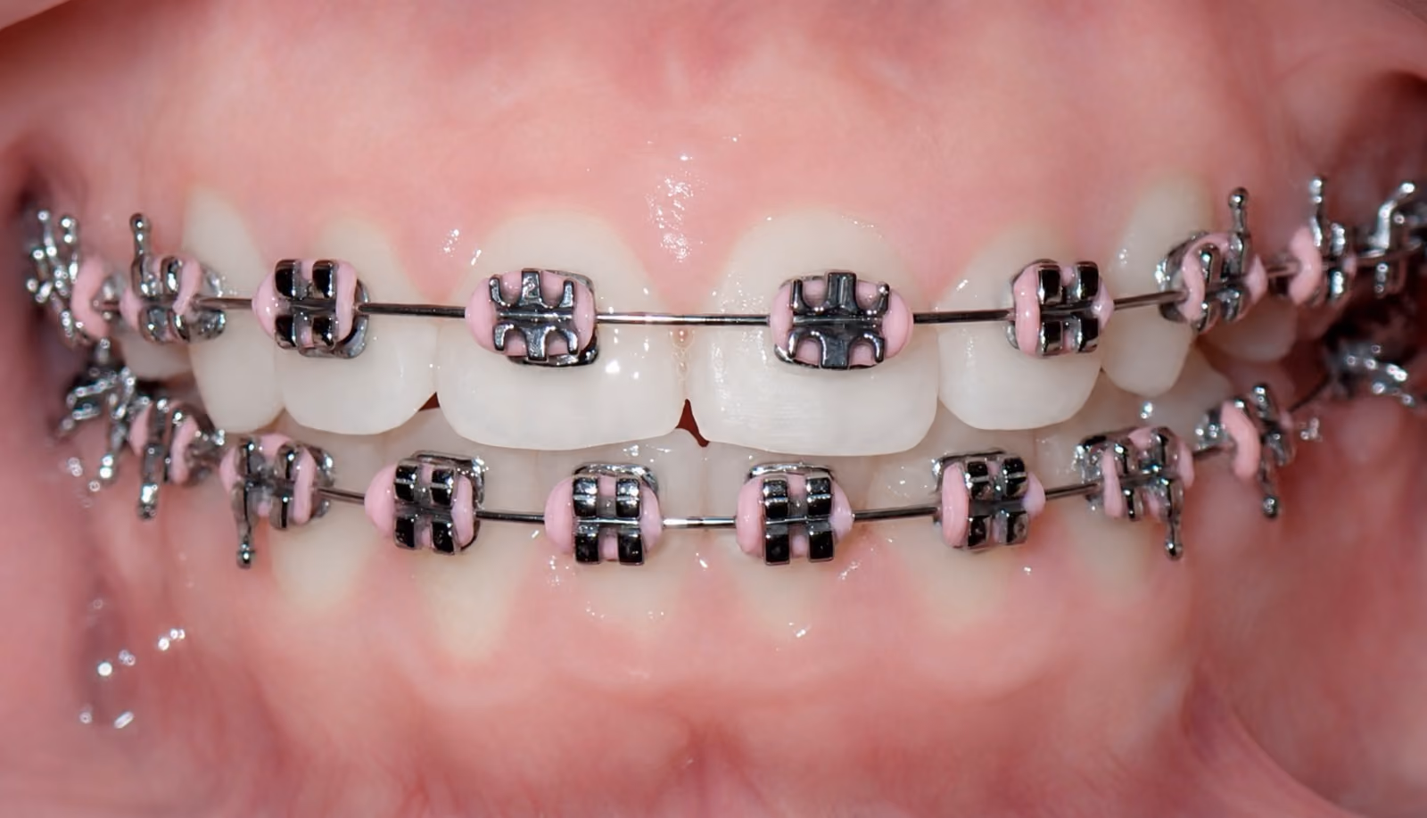 Traditional Braces