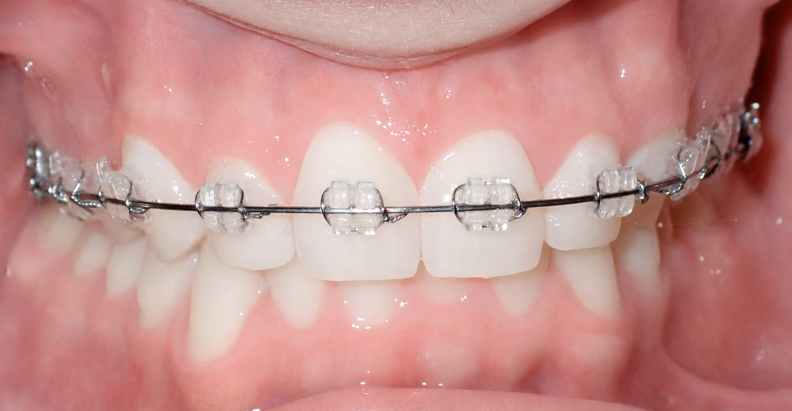 Clear Braces