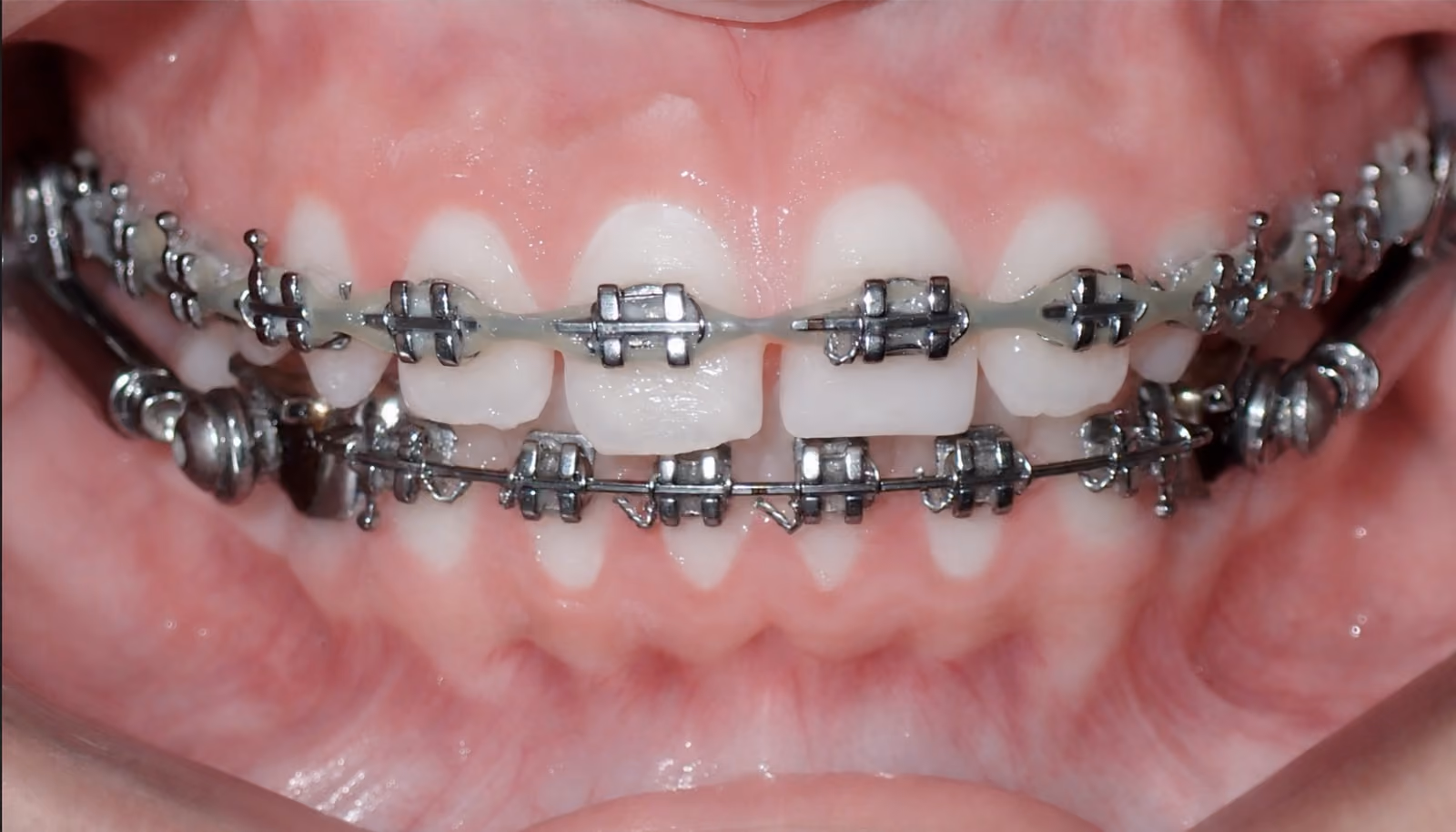 Premium Braces