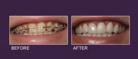 Veneer Before After 3