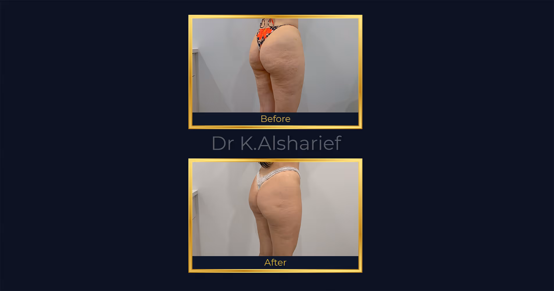 Halifax Morpheus8 body contouring, cellulite reduction, and mommy makeover before and after