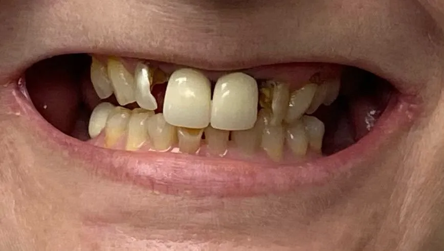 Close-up of a patient's worn and damaged natural teeth before implant treatment