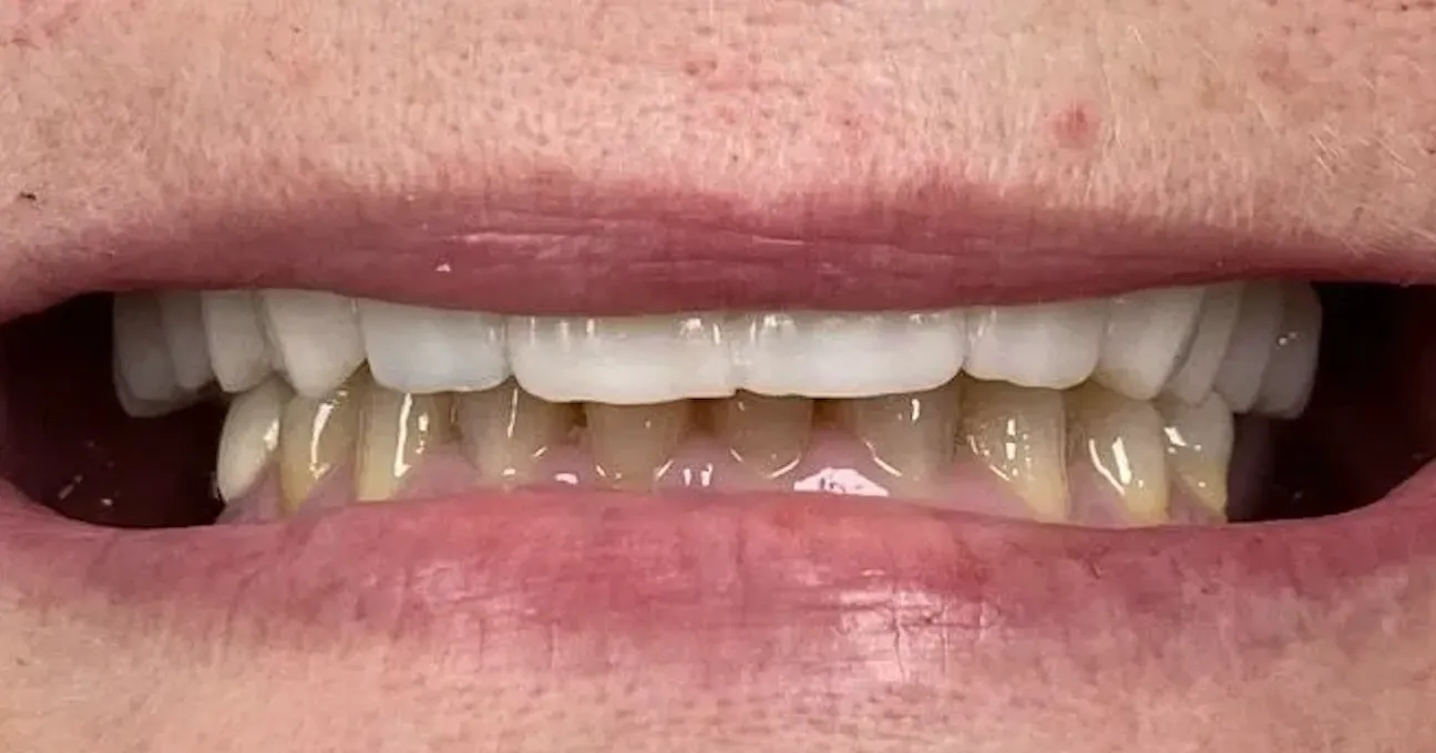 Close-up of a real patient's restored upper and lower teeth after dental treatment at Markham Family Dental