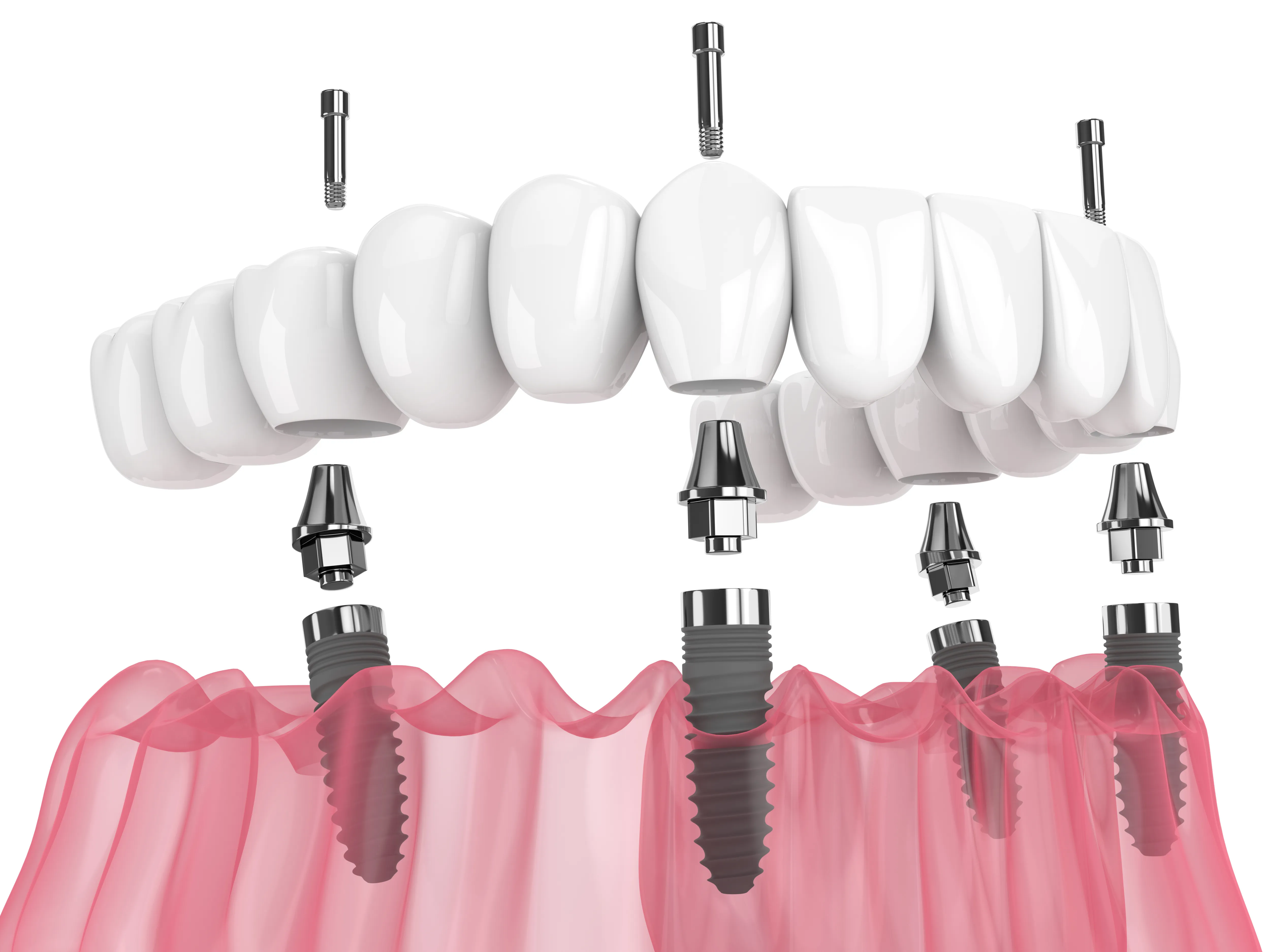 Illustration of an All-on-X full-arch restoration on several dental implants
