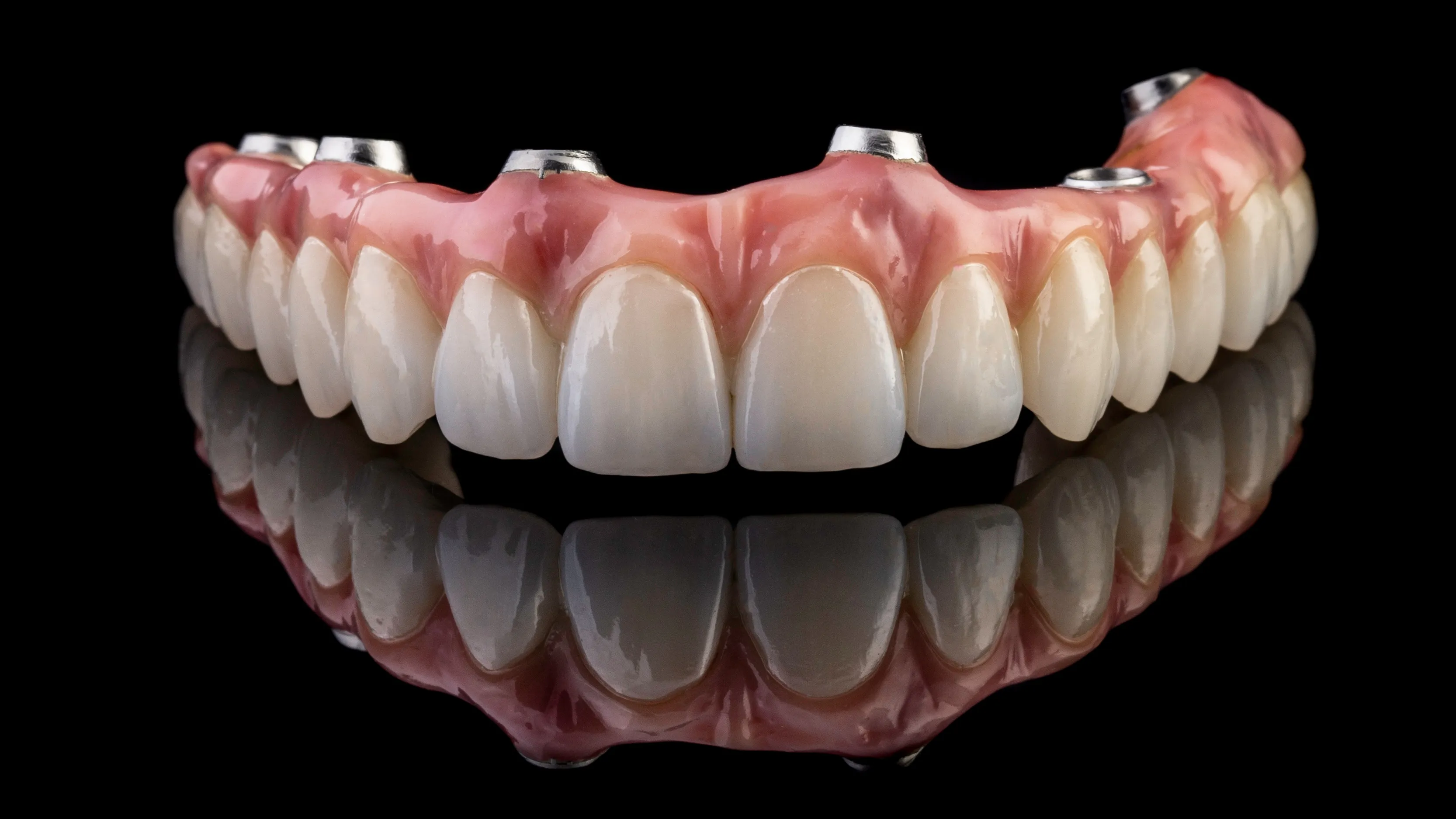 Underside of a full-arch implant-supported fixed denture showing its metal attachment points