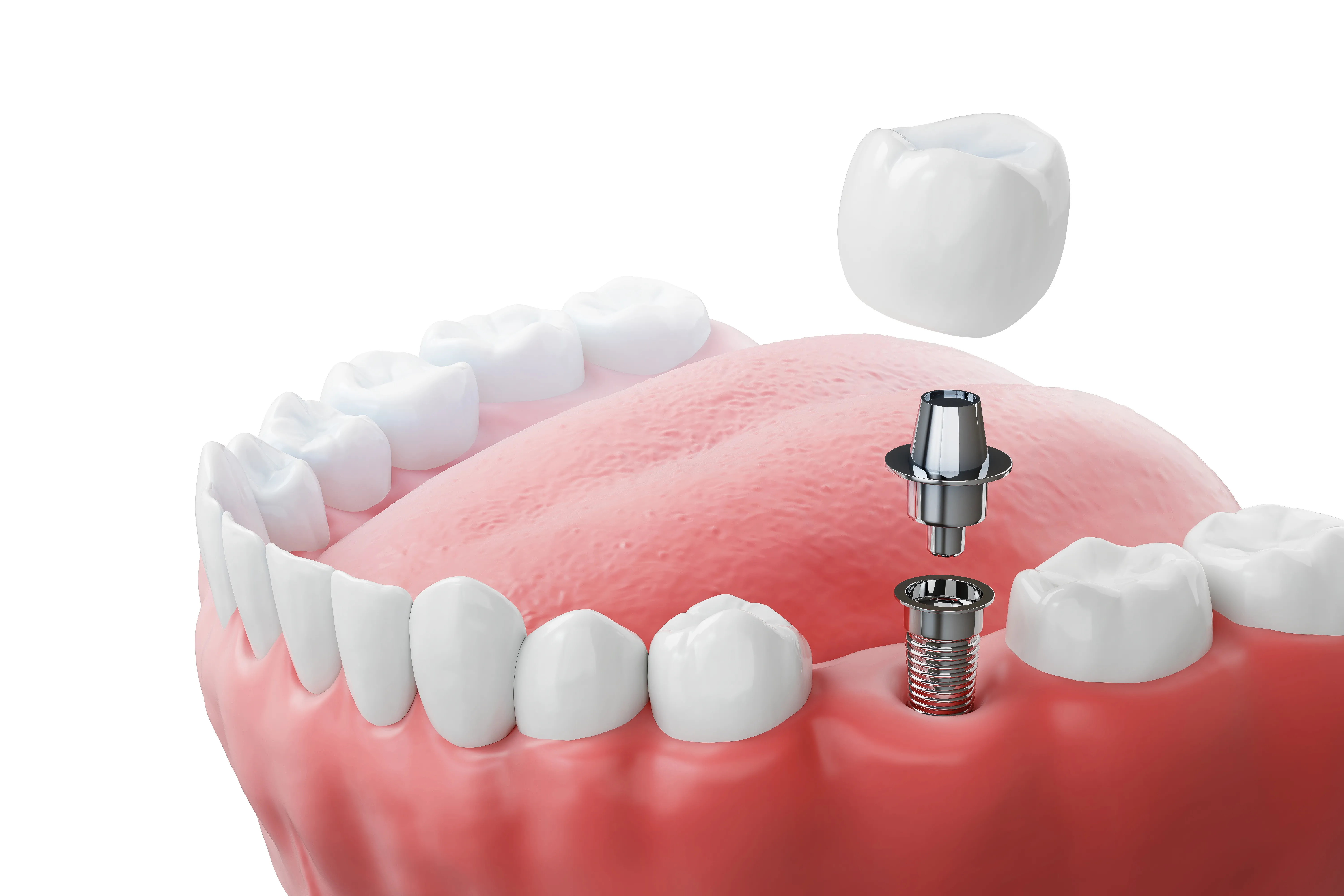 3D illustration of a single implant crown being placed onto an abutment in the lower jaw