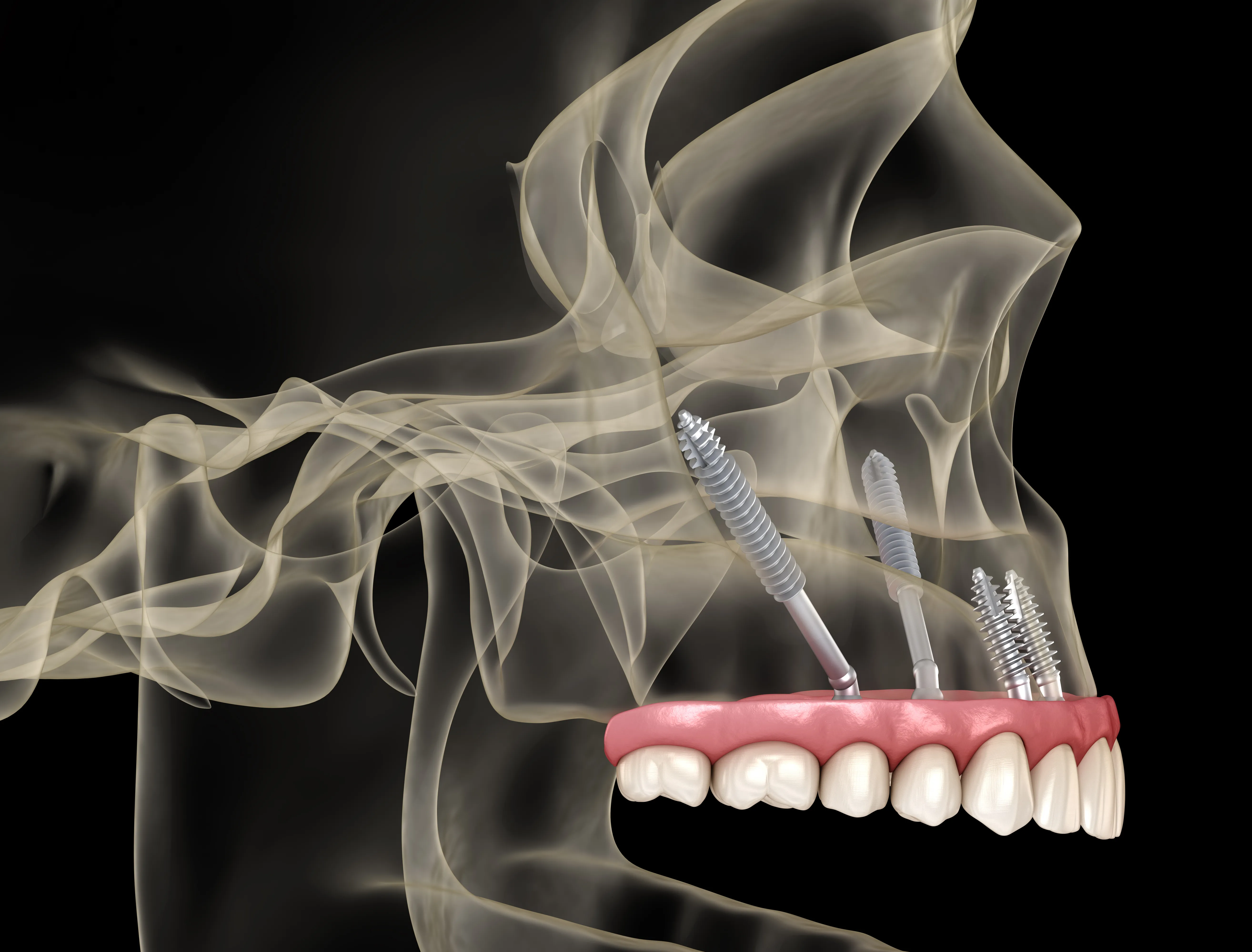 Illustration of zygomatic implants angled into the cheekbones to support an upper-arch restoration, shown in a transparent skull