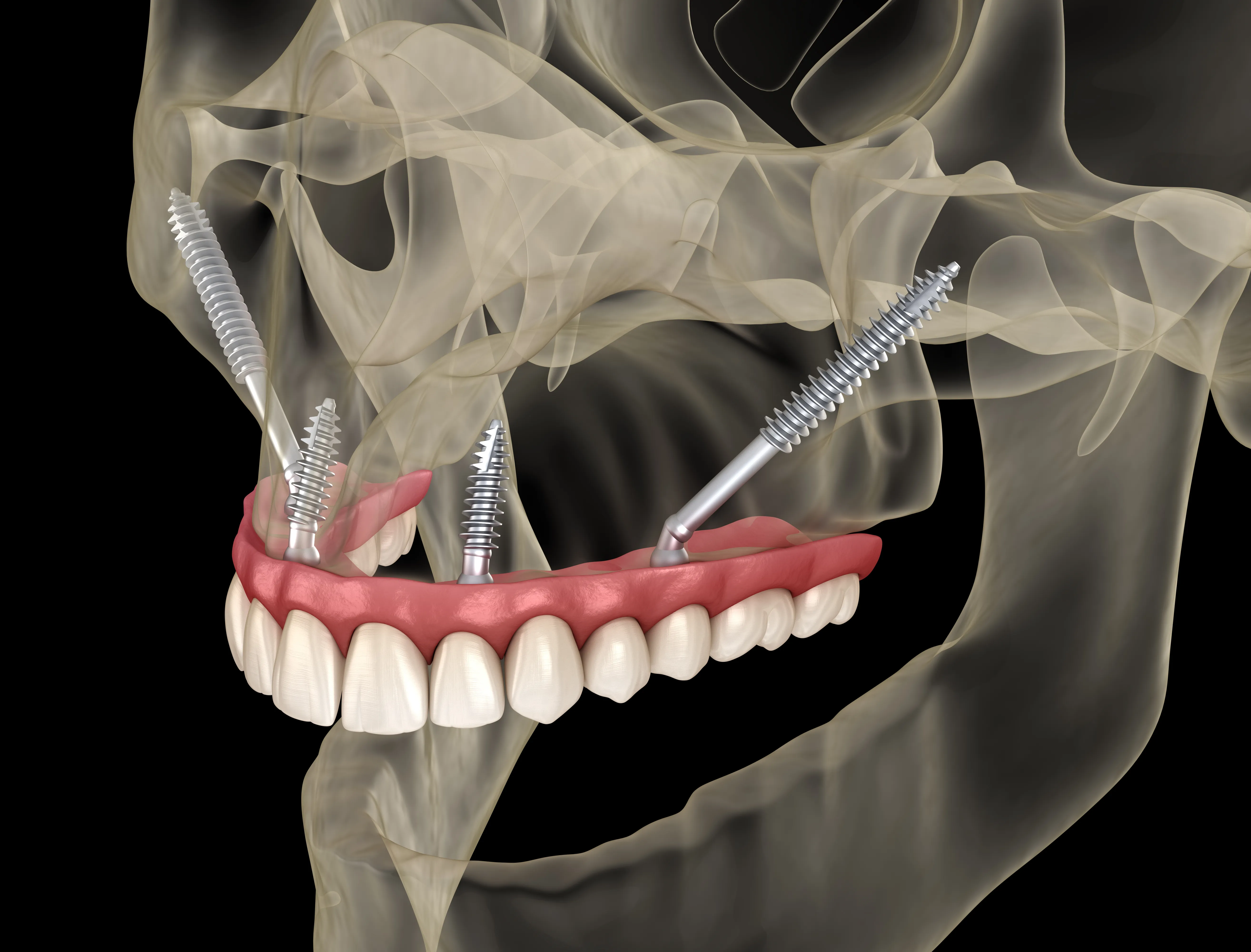 Illustration of angled dental implants anchoring a restoration in the lower jaw, shown in a transparent skull