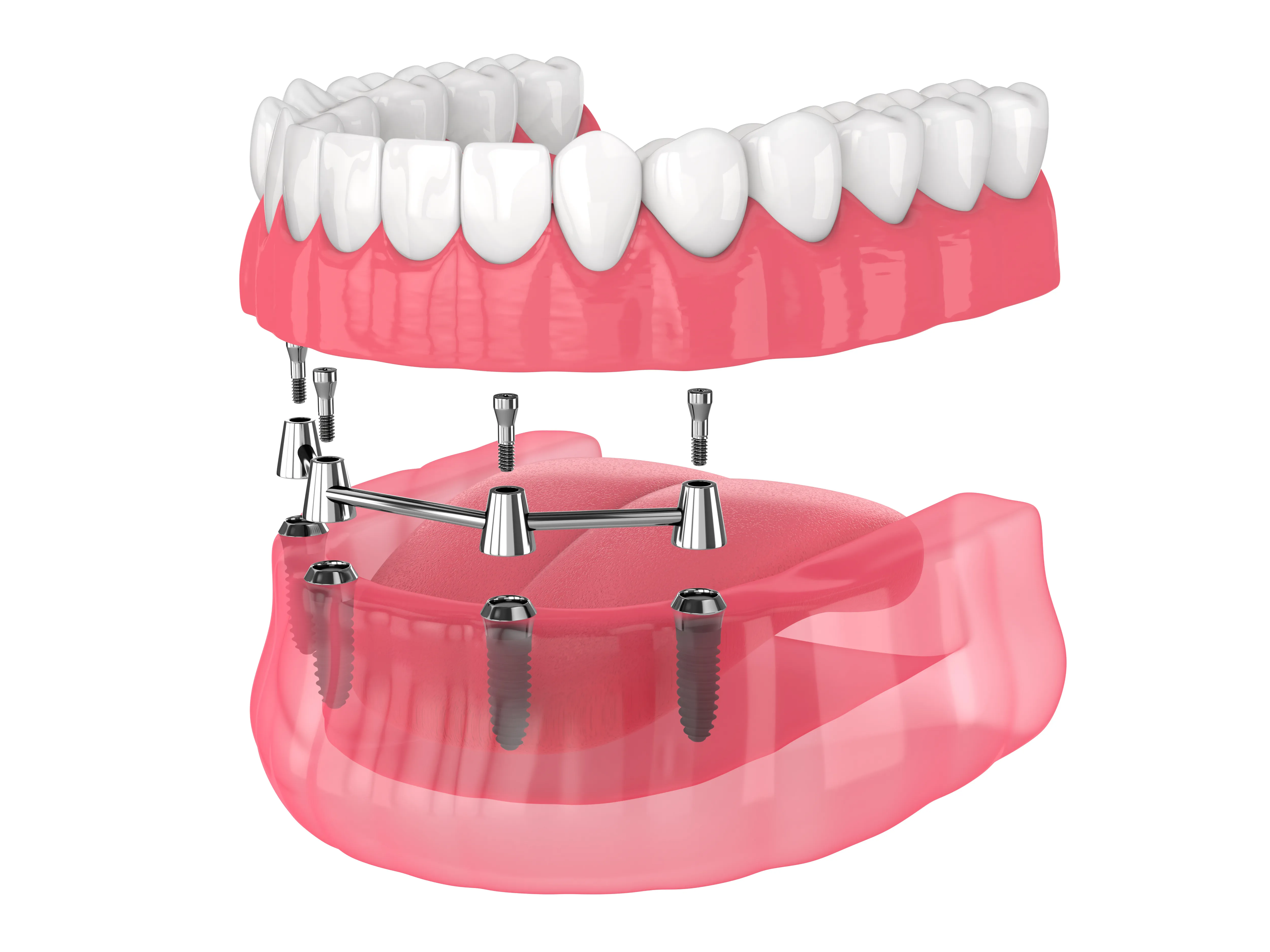 Illustration of a removable lower overdenture fitting over an implant-supported bar