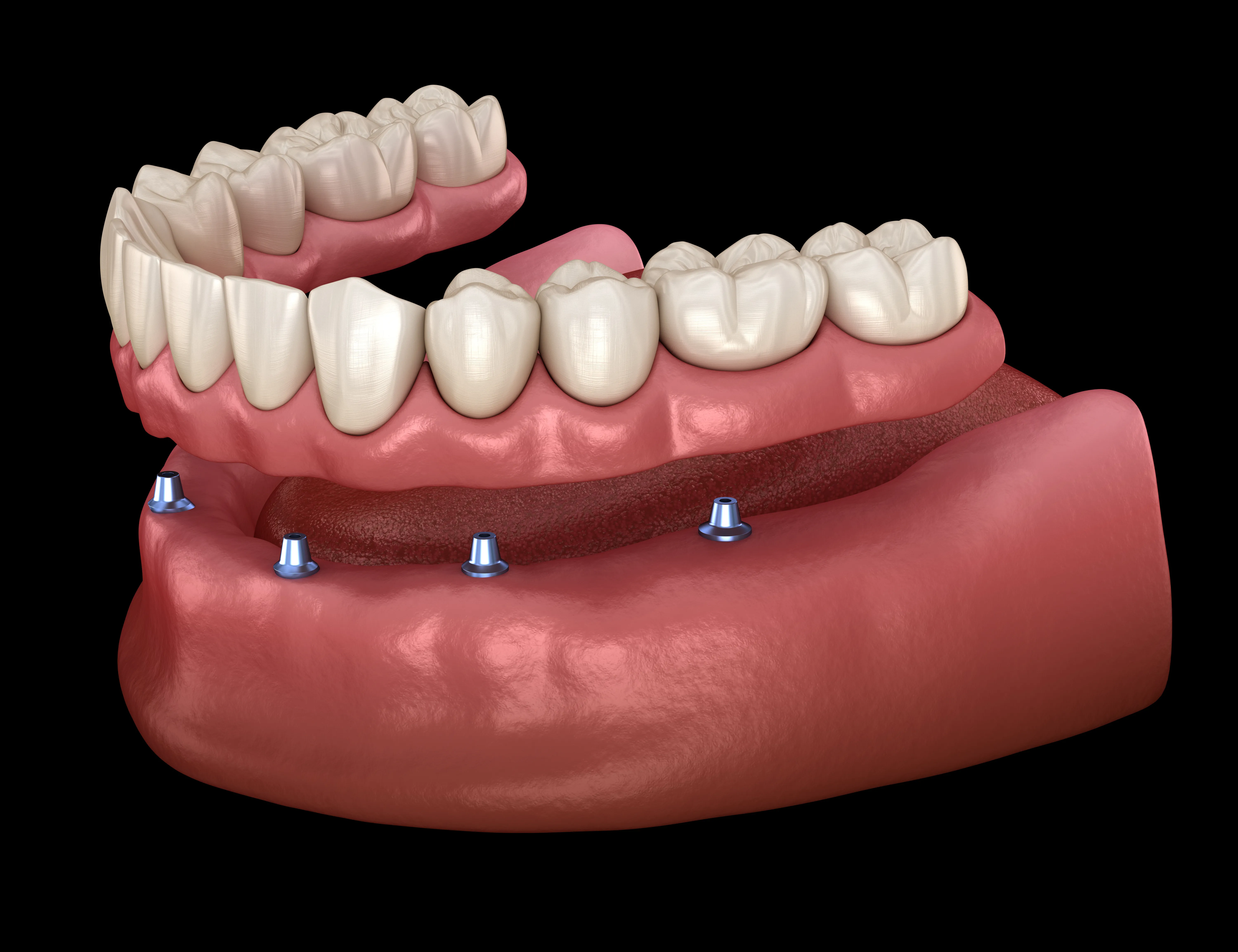3D illustration of a removable lower overdenture fitting over four ball-attachment implants