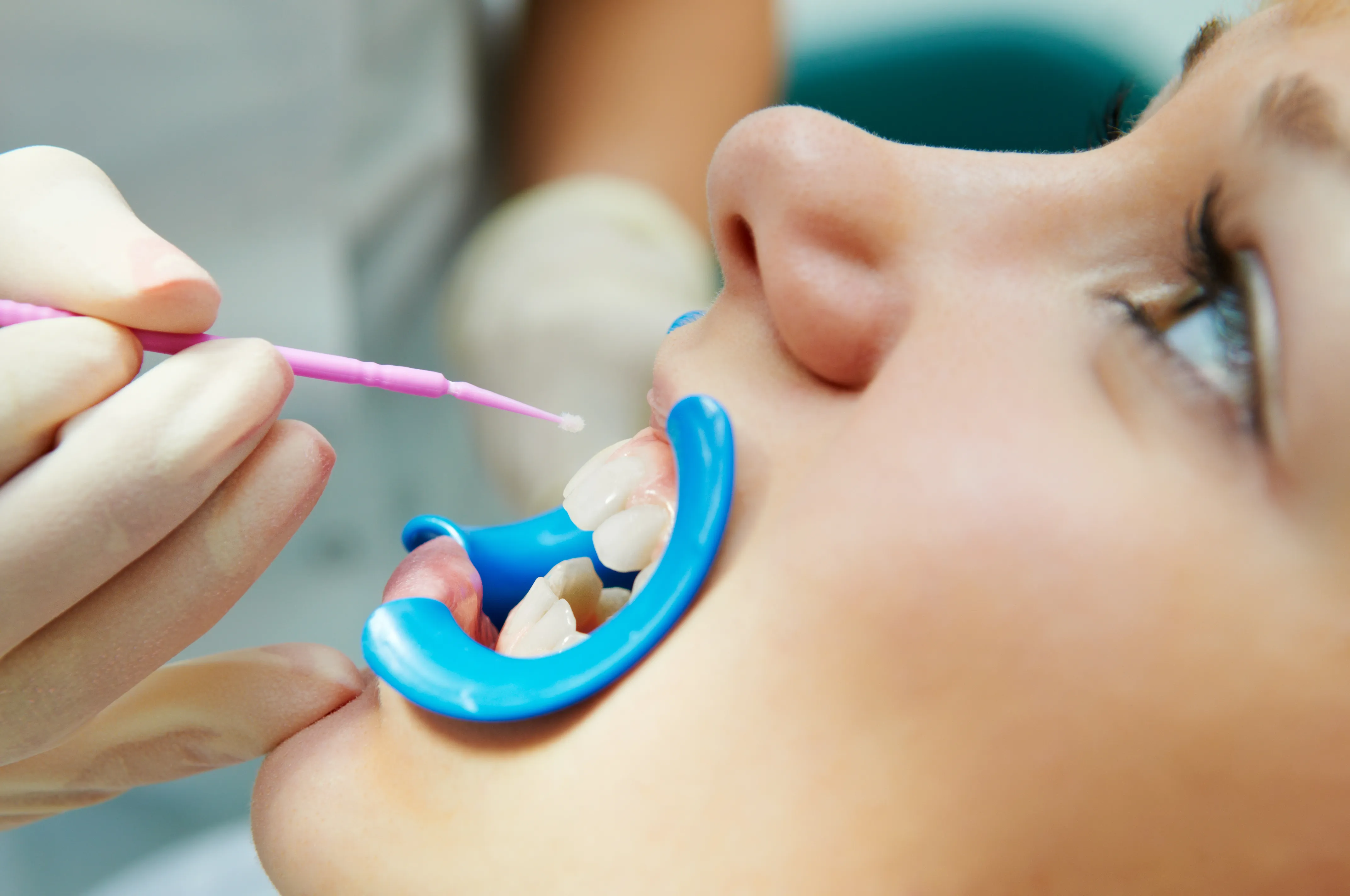 Close-up of a dental sealant being brushed onto a patient's teeth with a lip retractor in place