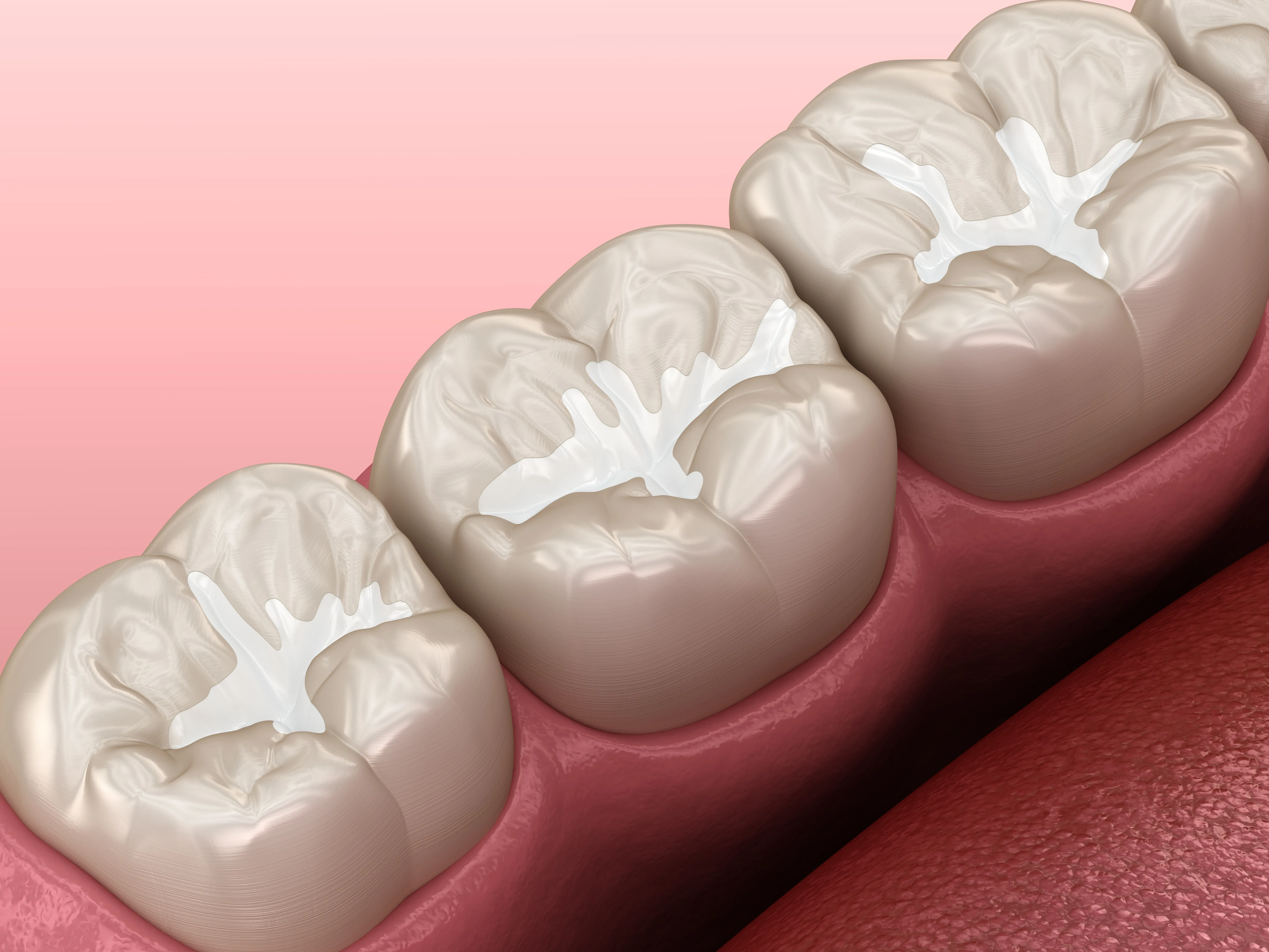 3D illustration of white dental sealant filling the grooves of the back molars