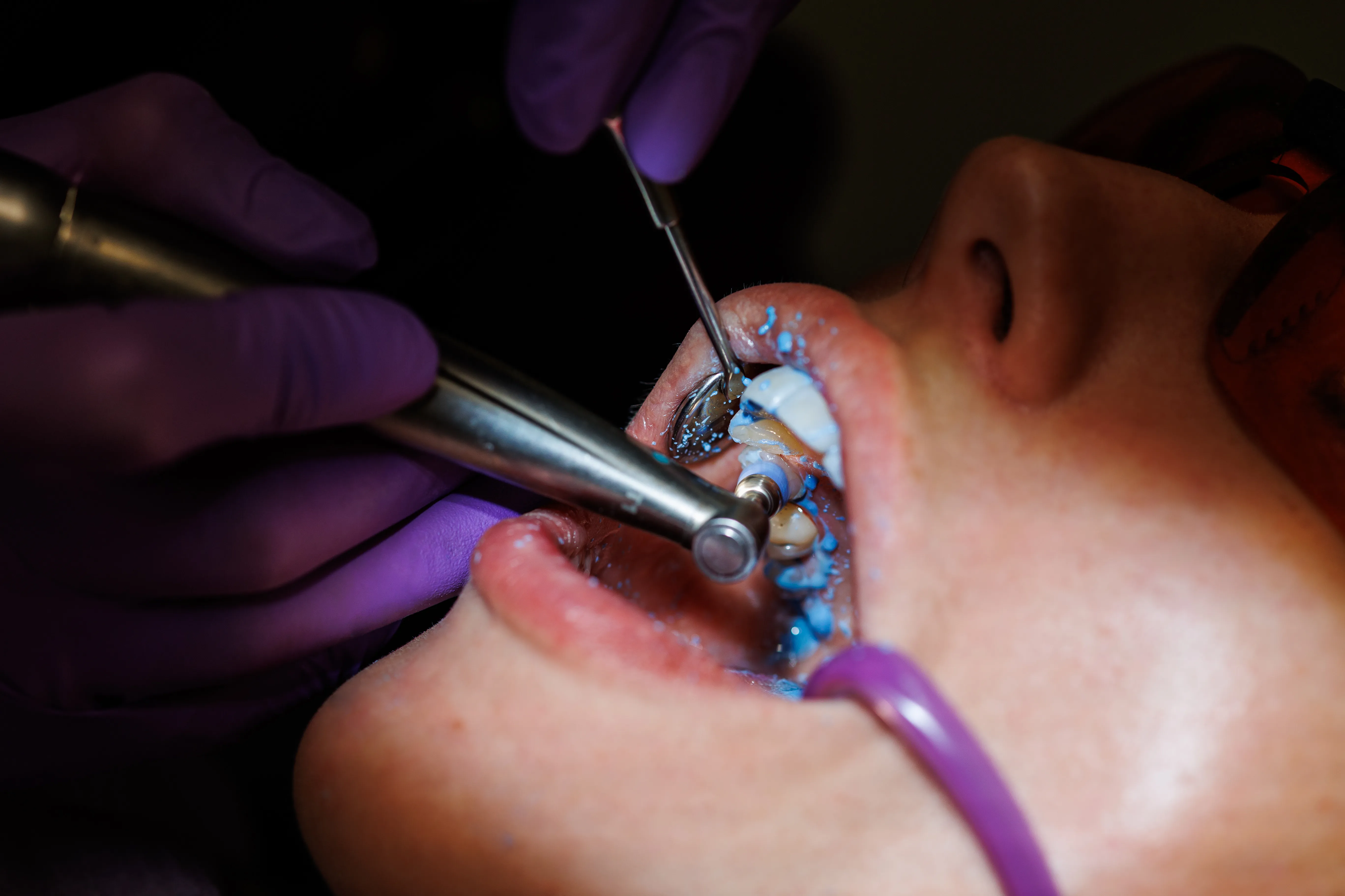 Close-up of a dentist applying preventive material to a patient's teeth with a handpiece
