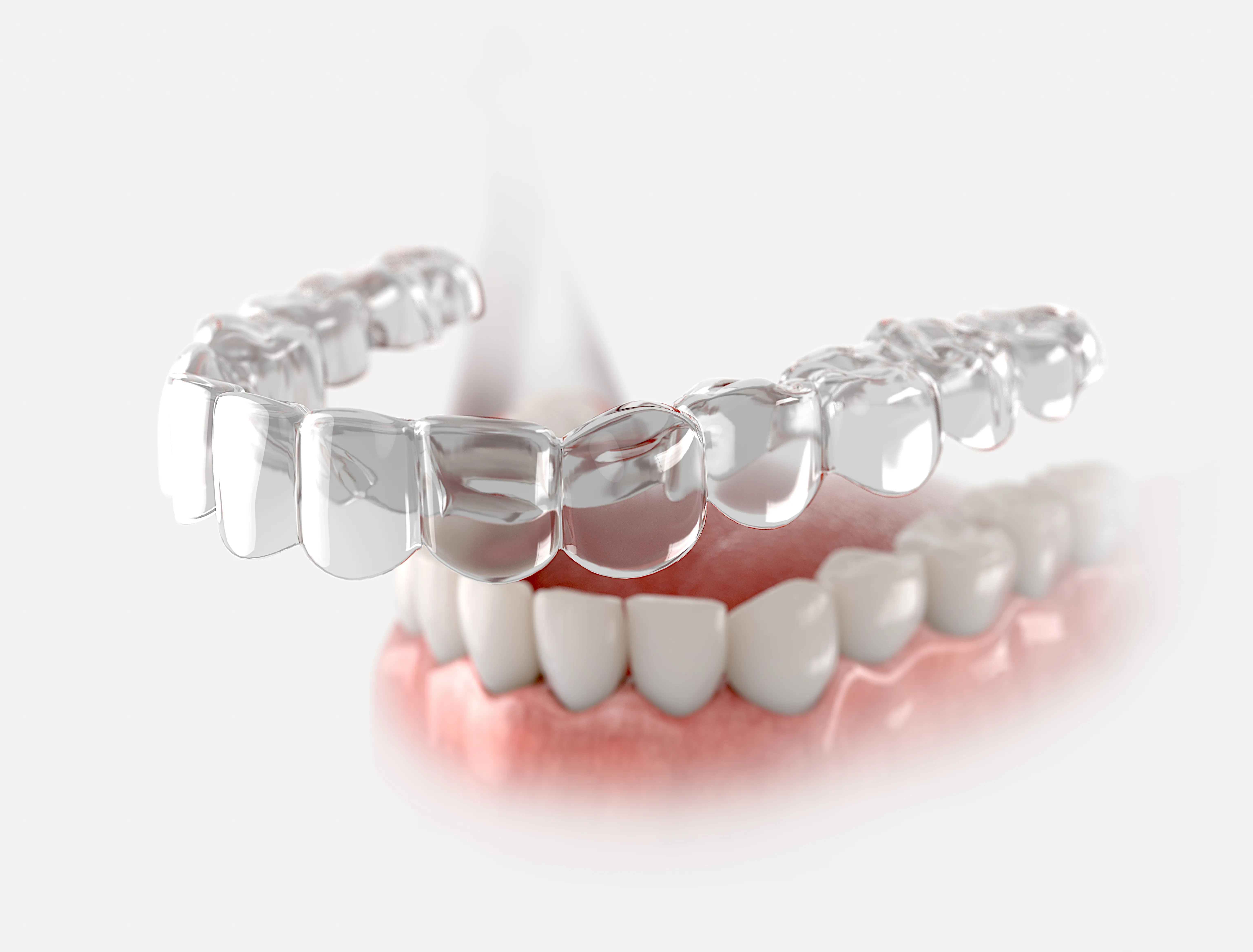 3D illustration of a clear aligner tray being placed onto a lower arch of teeth