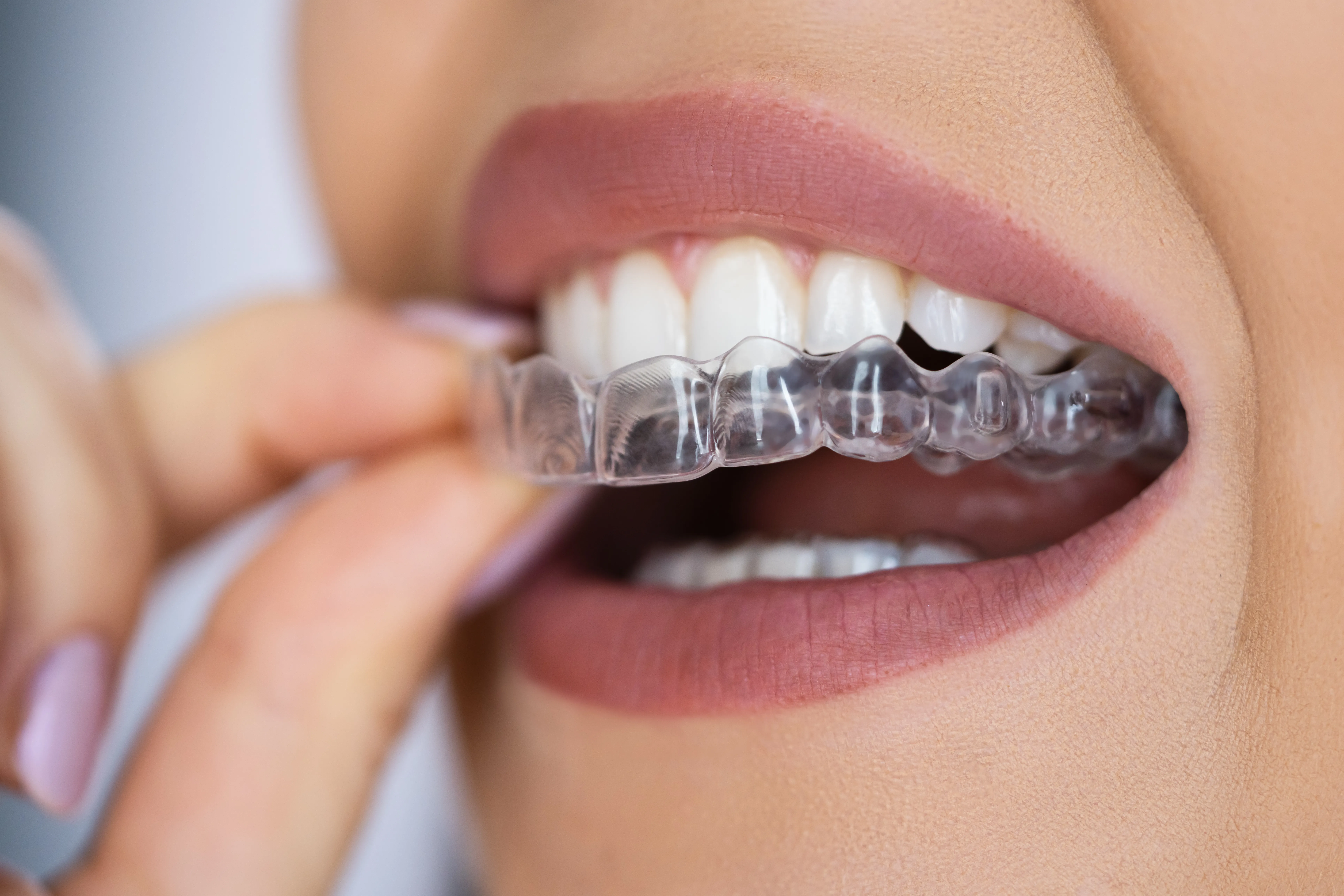 Close-up of a smiling woman placing a clear aligner tray onto her upper teeth with her fingertips