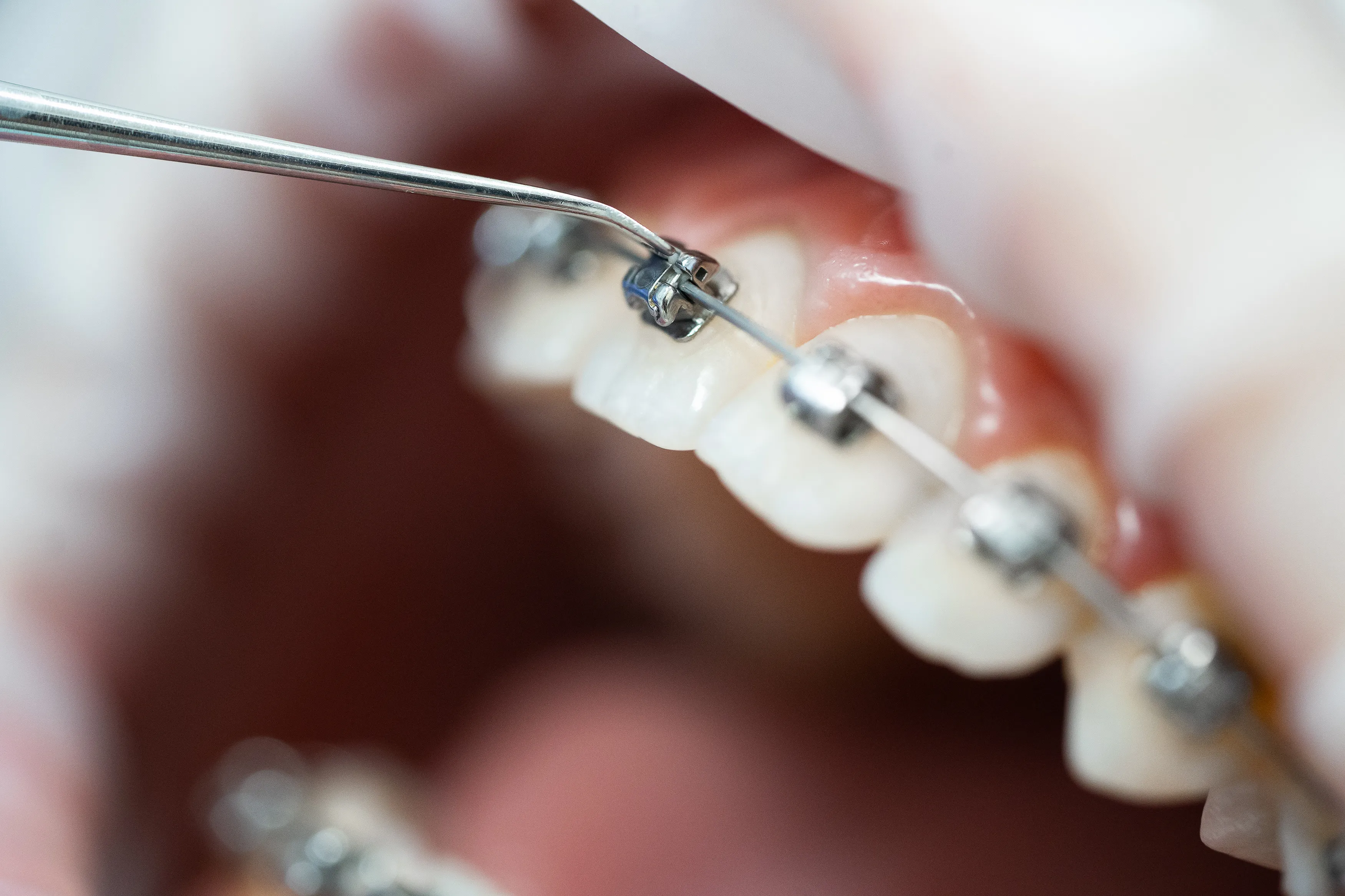 Macro close-up of metal braces on upper teeth with a dental tool adjusting the archwire
