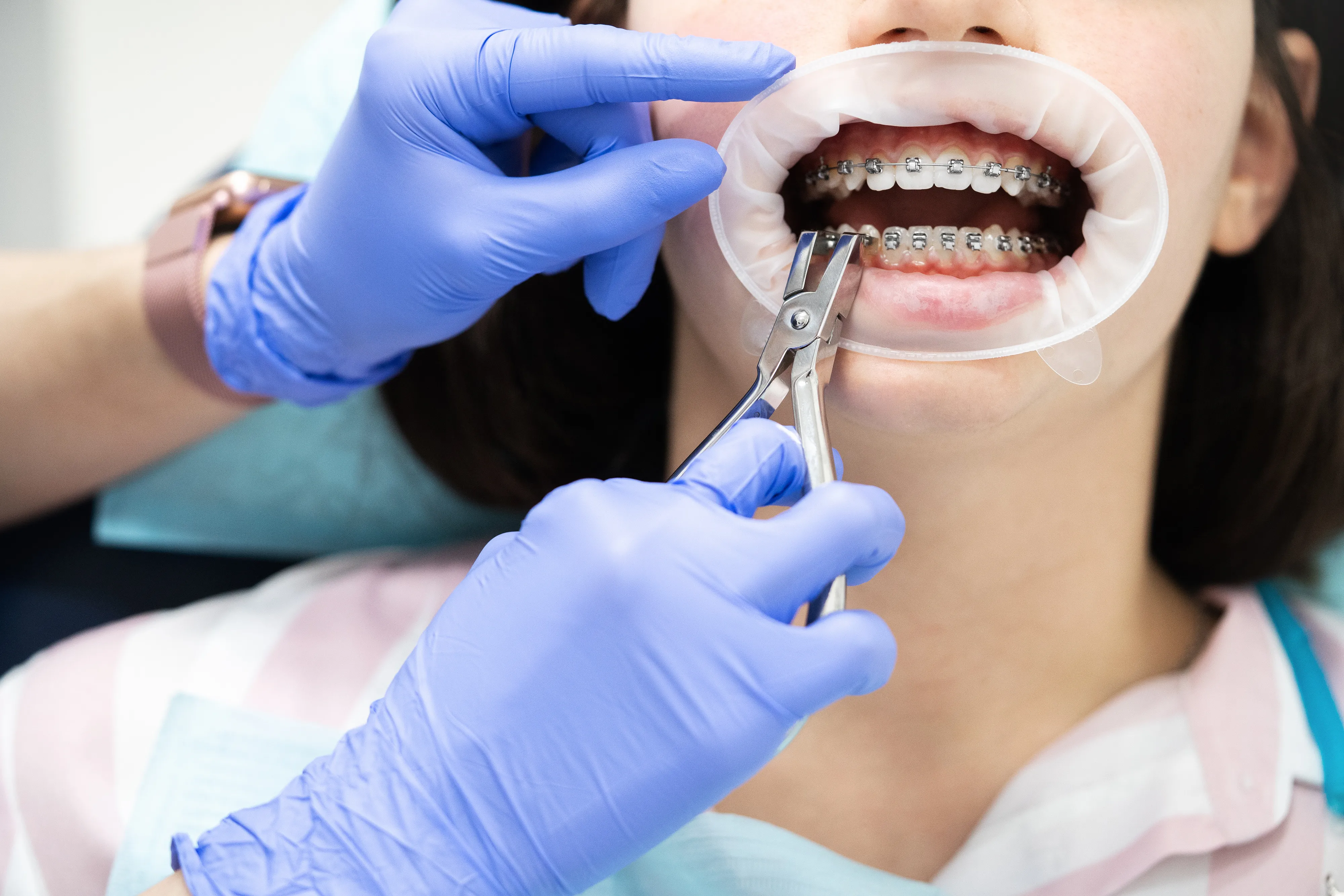 Patient with a cheek retractor having clear braces adjusted by a dentist's gloved hands