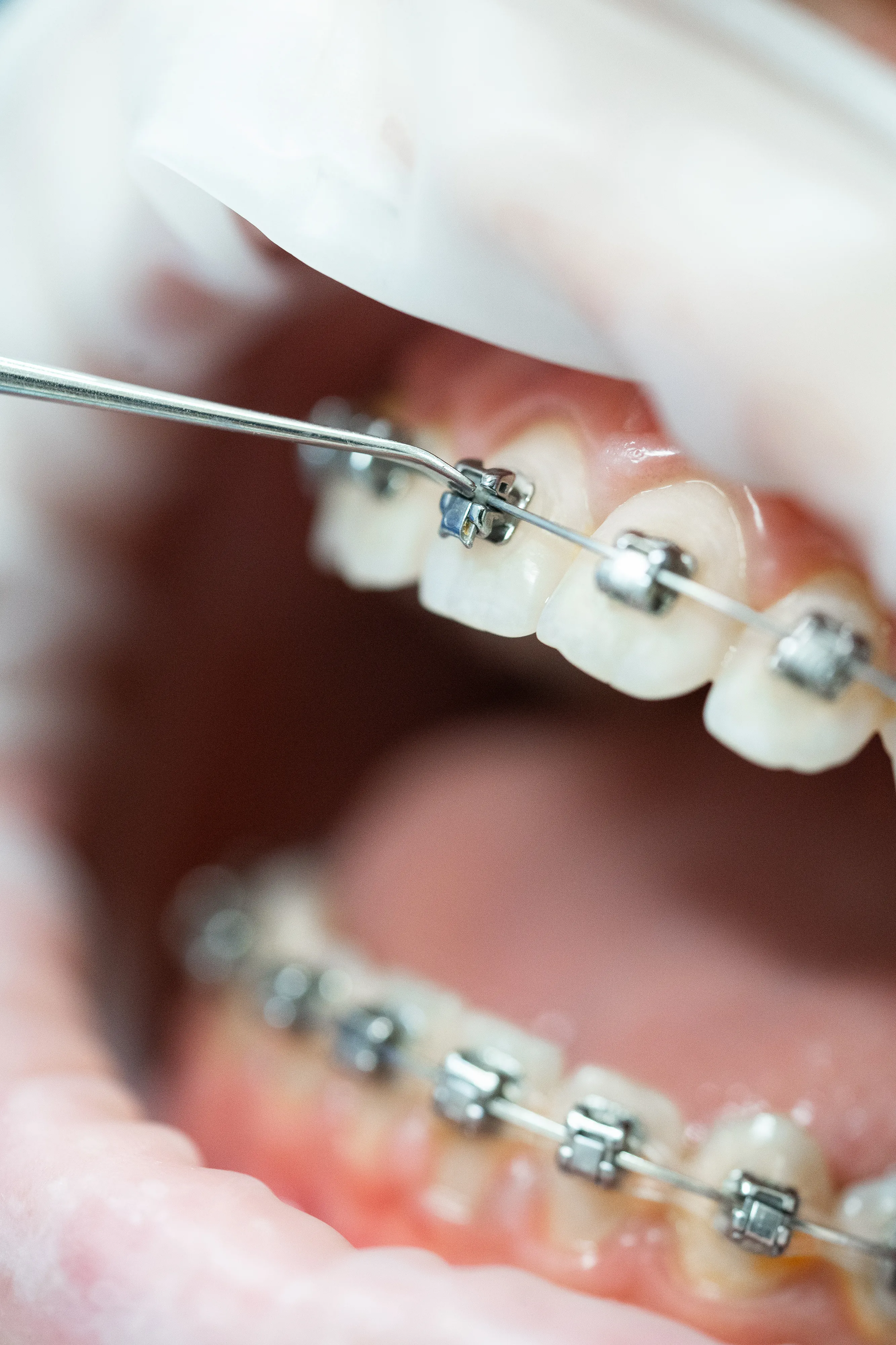 Macro close-up of metal braces on lower teeth with a dental probe touching a bracket