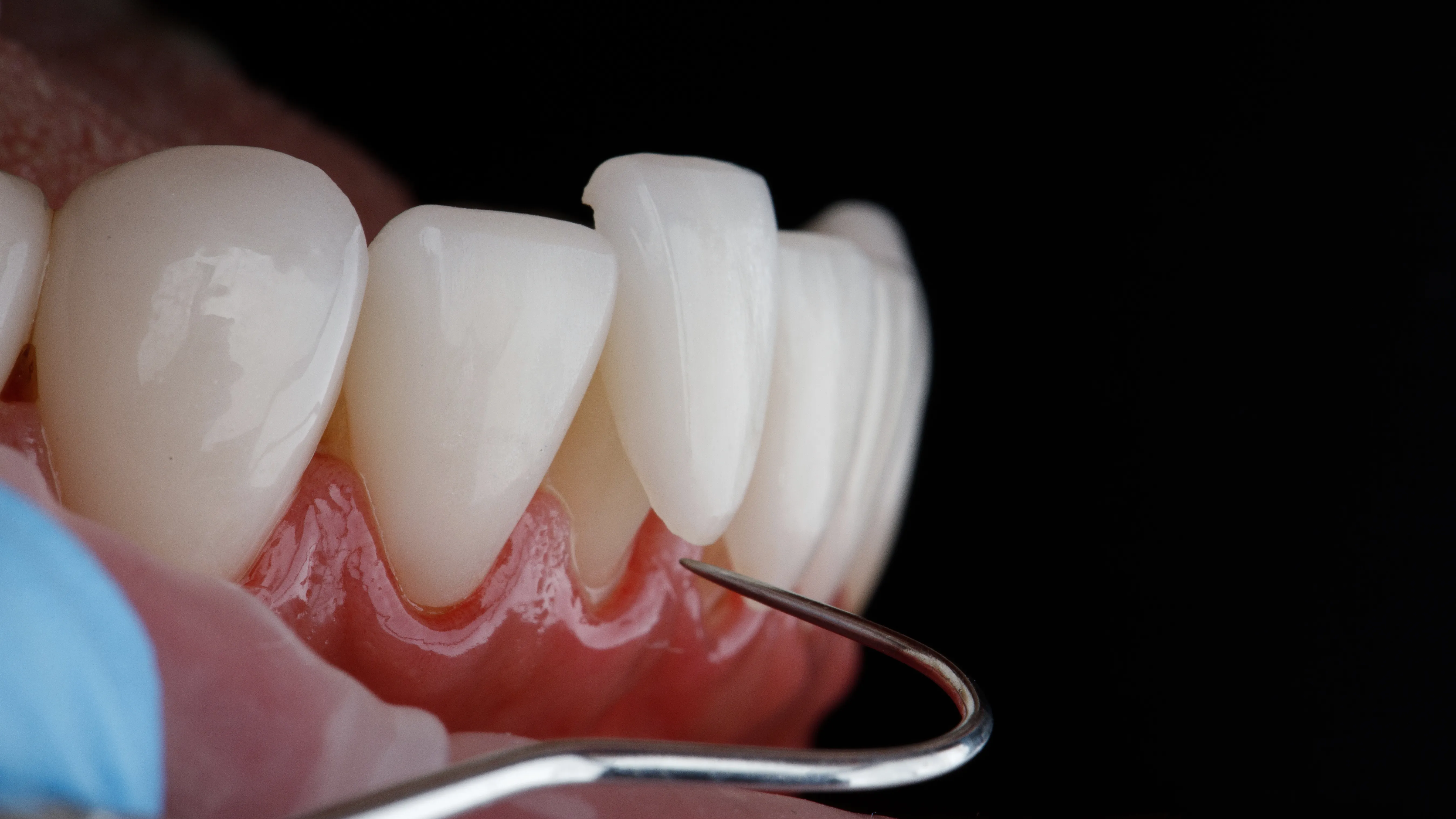 Macro close-up of porcelain veneers on lower front teeth with a dental probe, on a black background