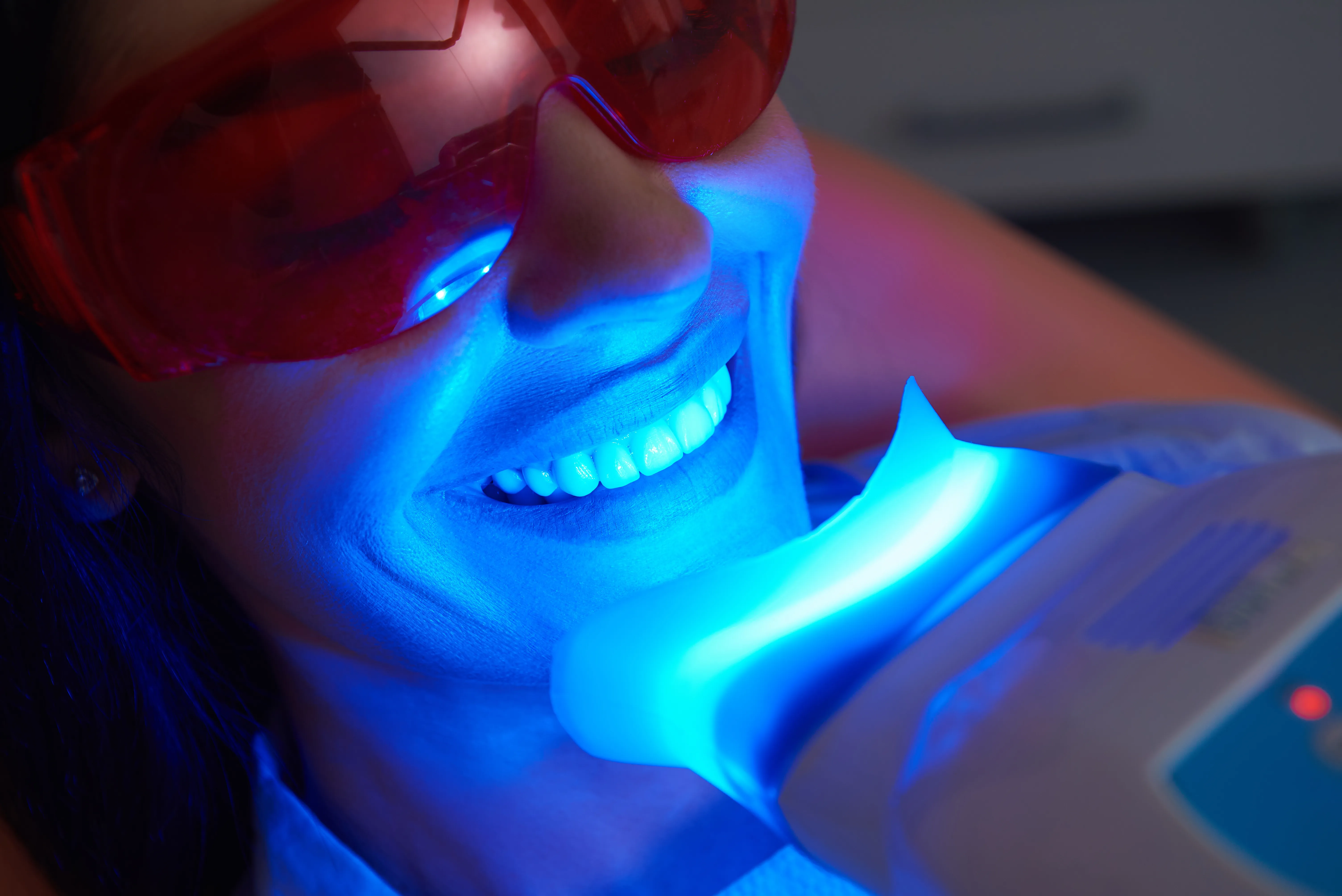 Close-up of a patient in red protective eyewear and a mouth retractor during blue-LED teeth whitening