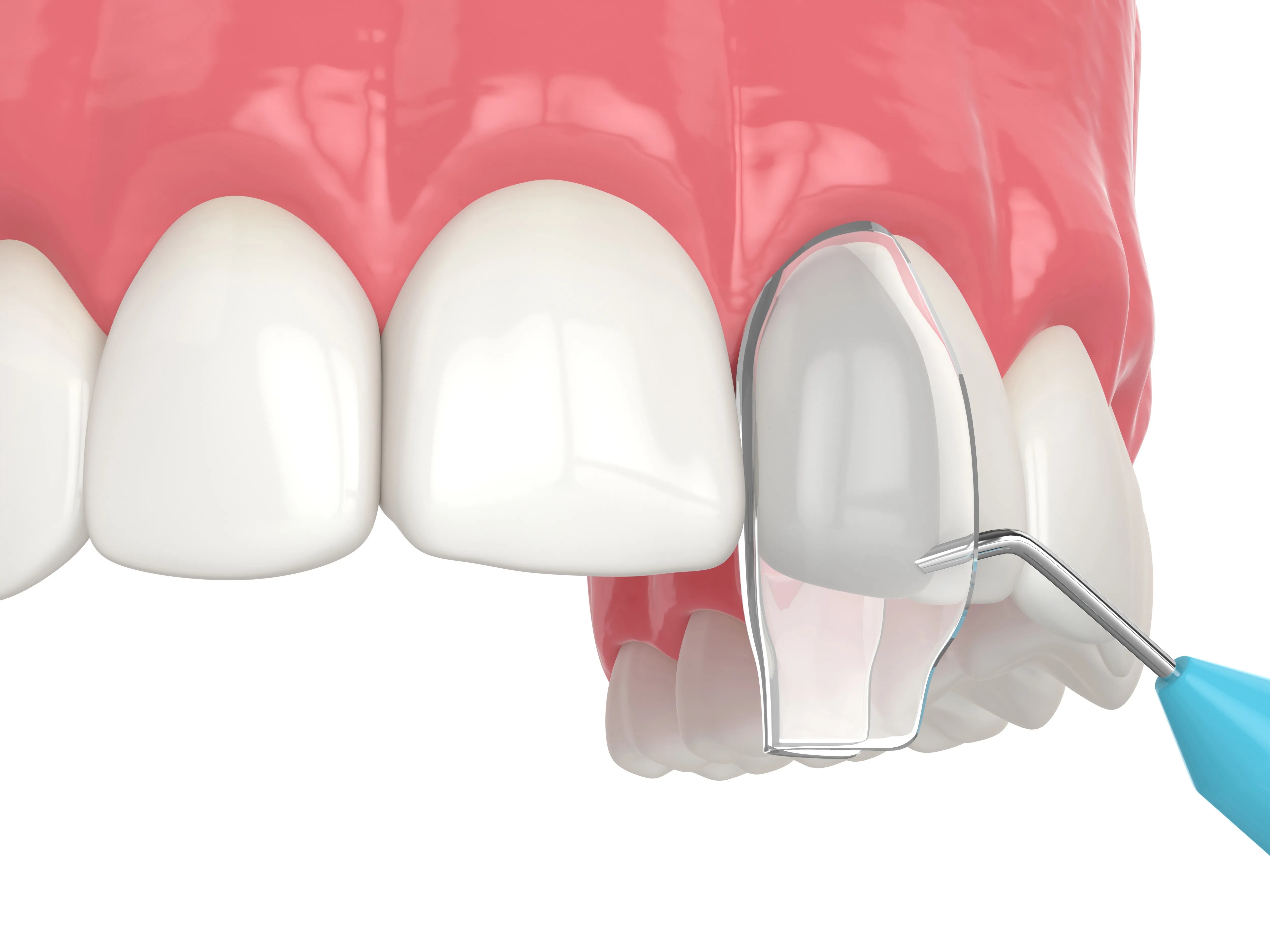 3D illustration of a porcelain veneer being bonded onto a front tooth of an upper-jaw model