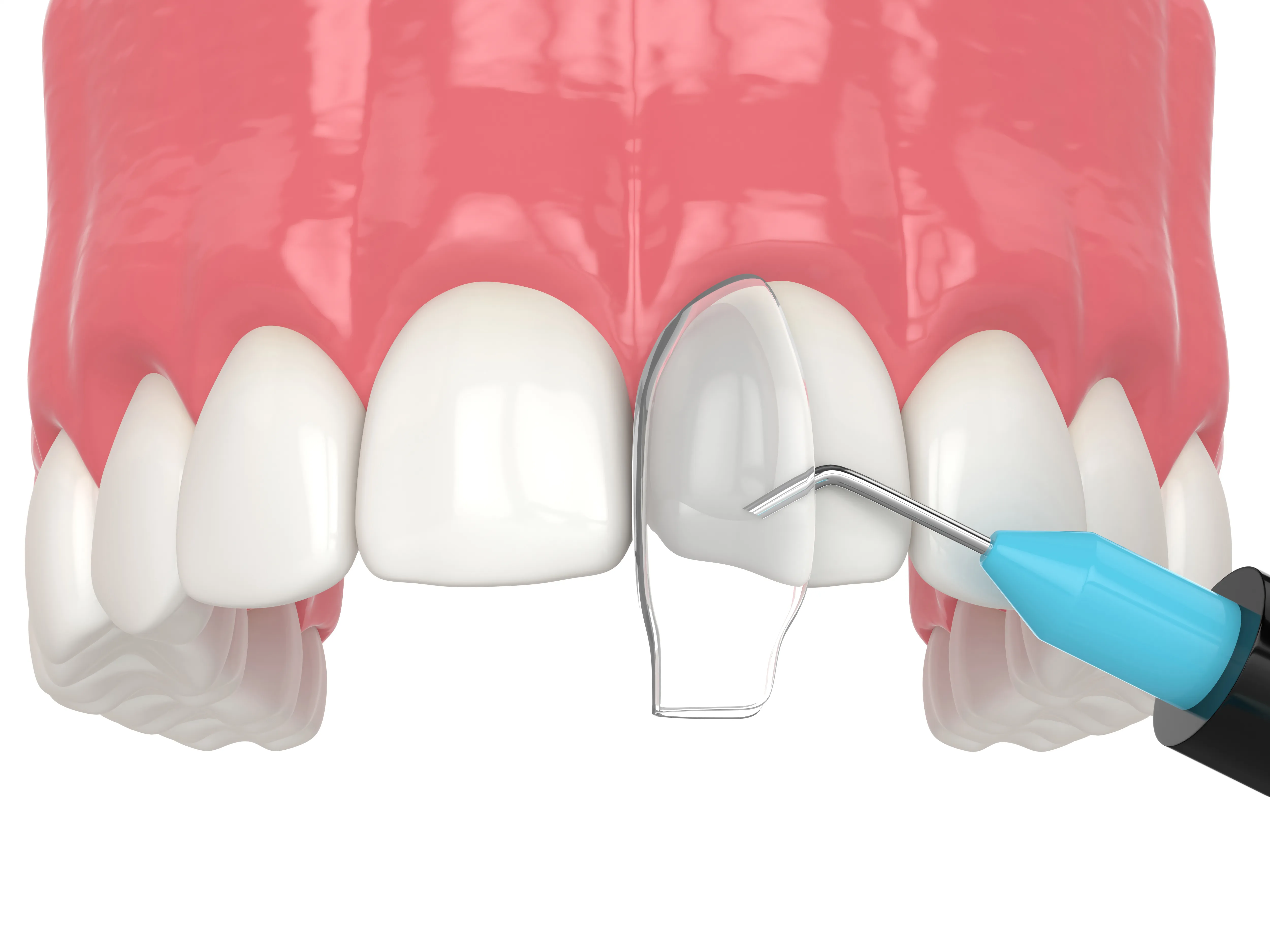 3D illustration of tooth-colored bonding resin being applied to a chipped upper front tooth with a dental instrument