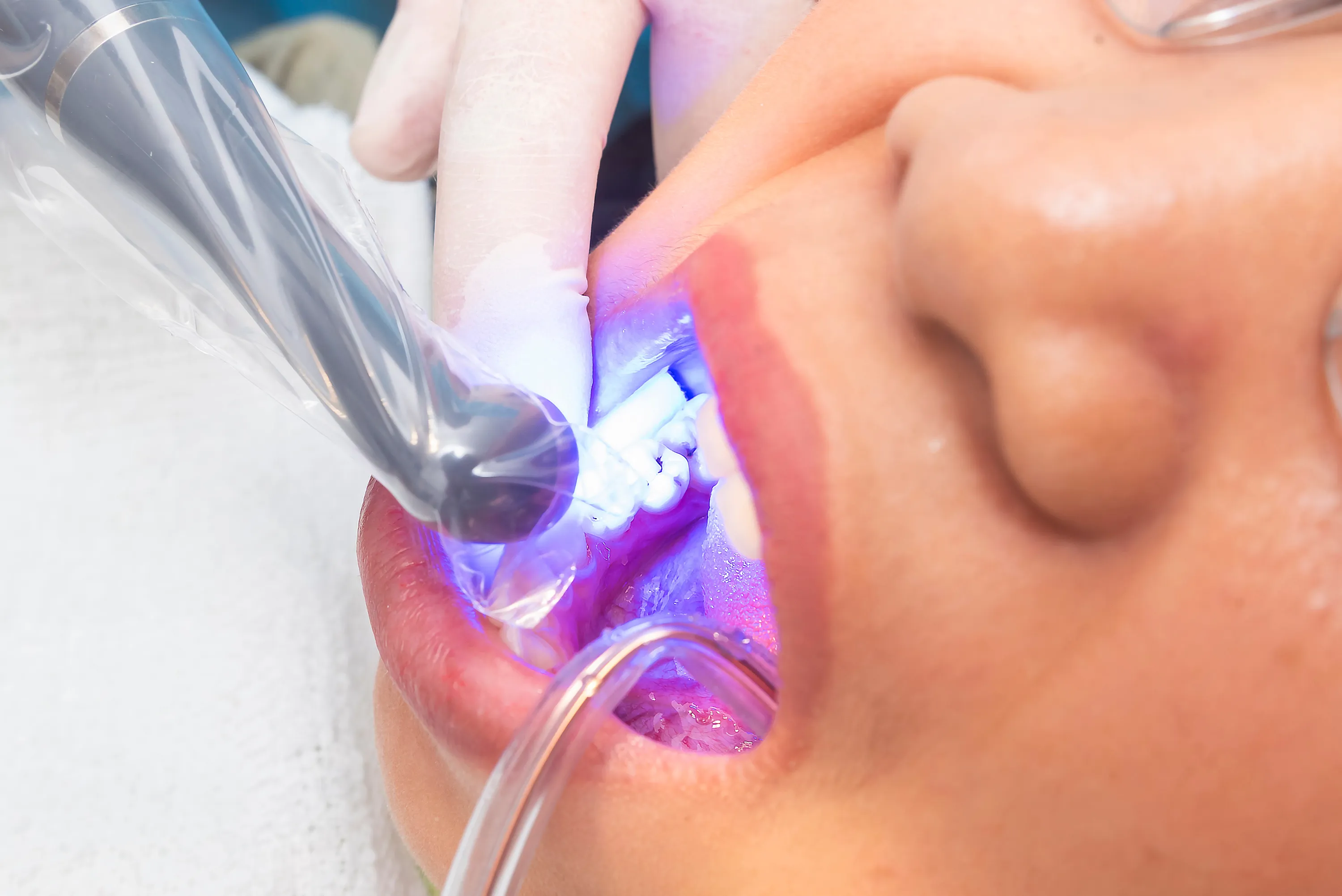 Patient having a tooth treated with a blue curing light to set tooth-colored bonding material
