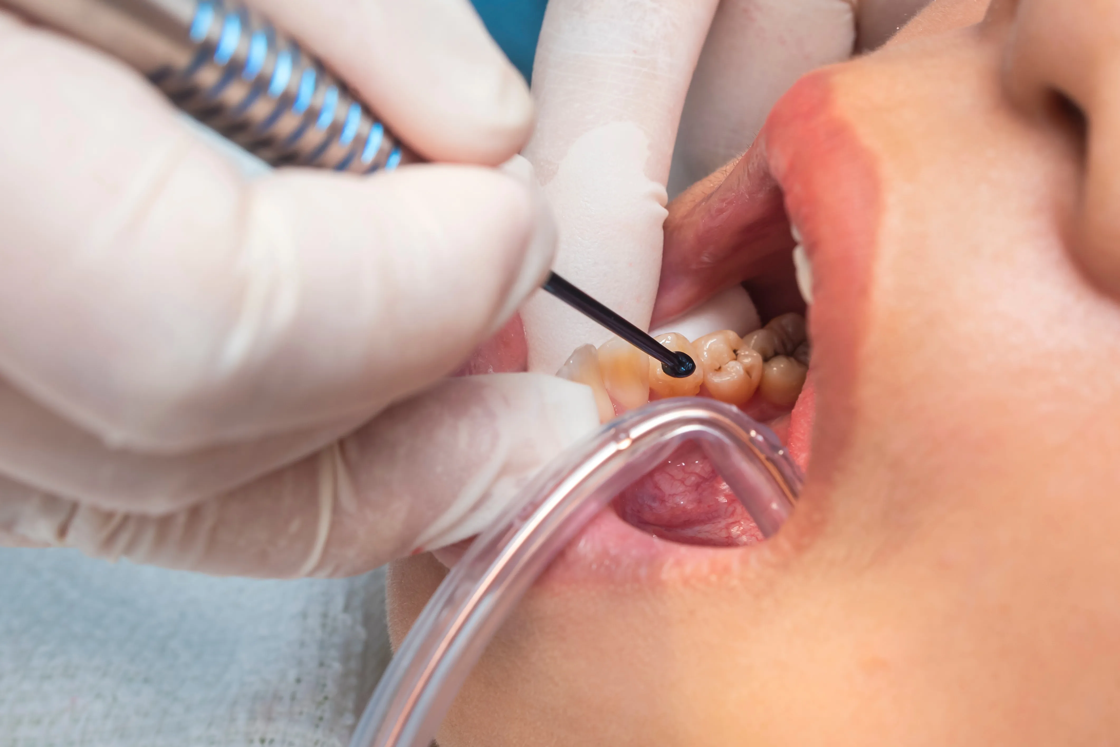 Close-up of a patient's retracted lips while a dentist uses an instrument and suction to place a filling