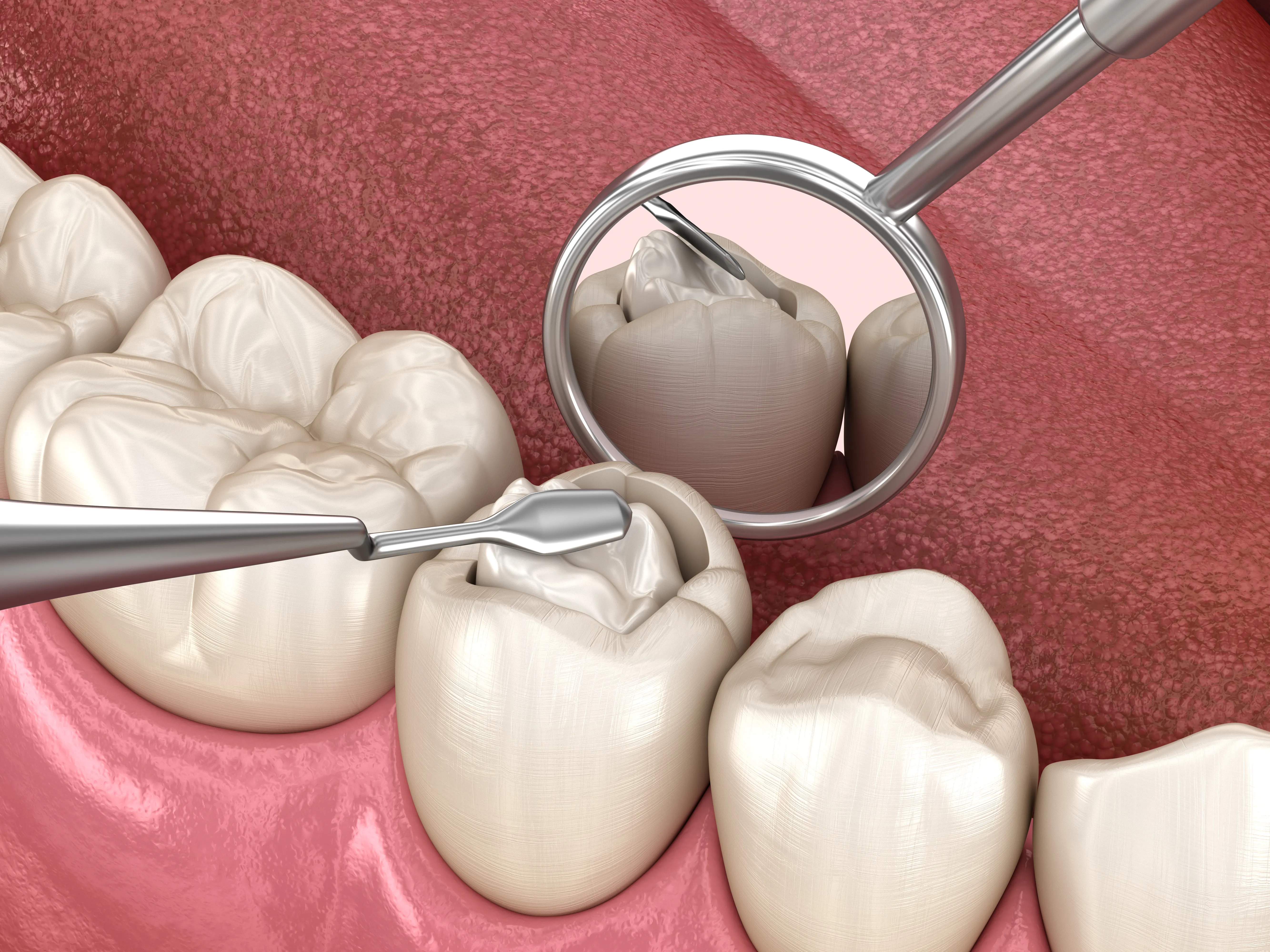 3D illustration of a back tooth restored with a tooth-colored filling, shown in a dental mouth mirror
