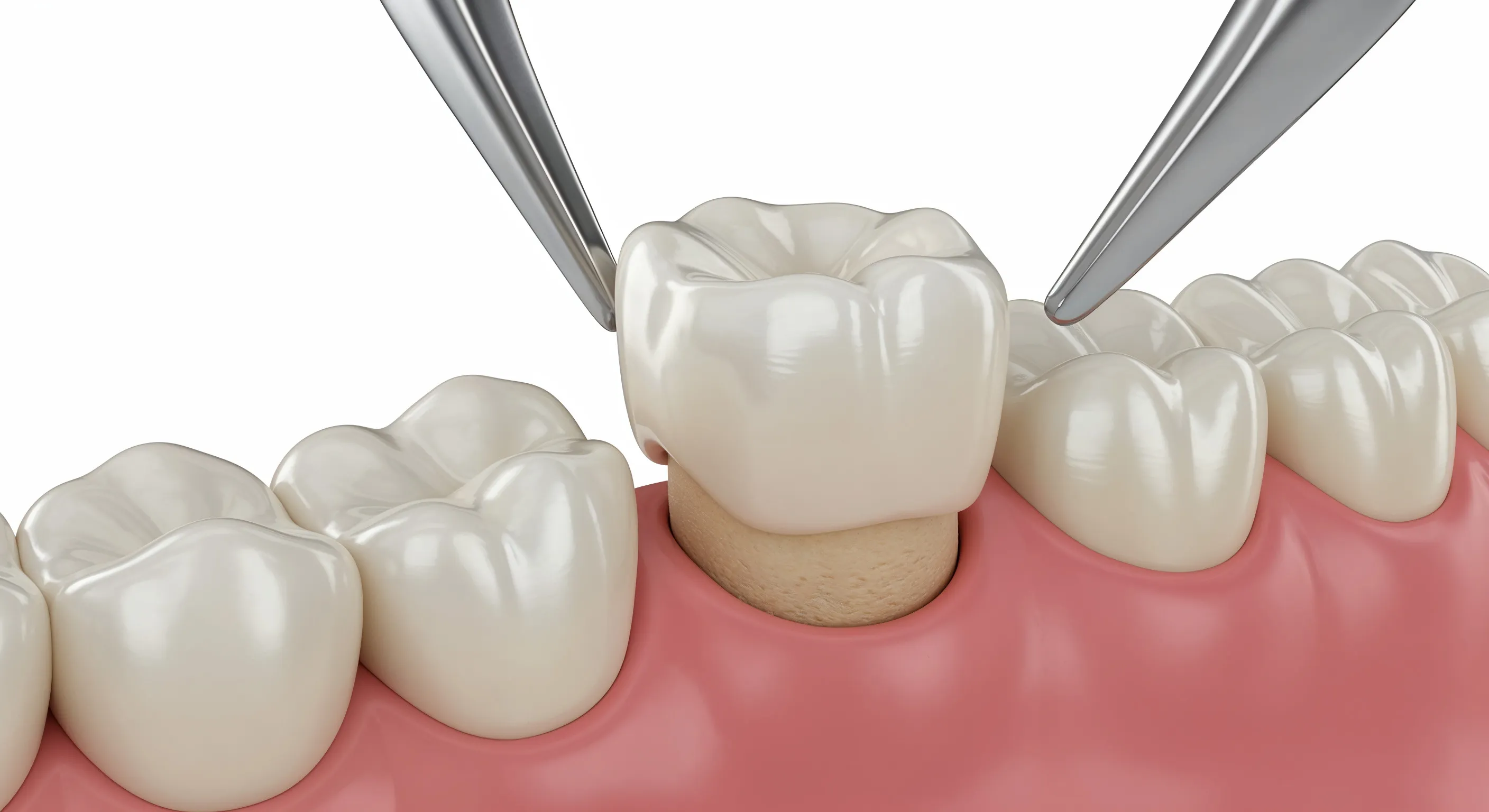 3D illustration of a dental crown held with forceps and placed onto a prepared lower molar between natural teeth