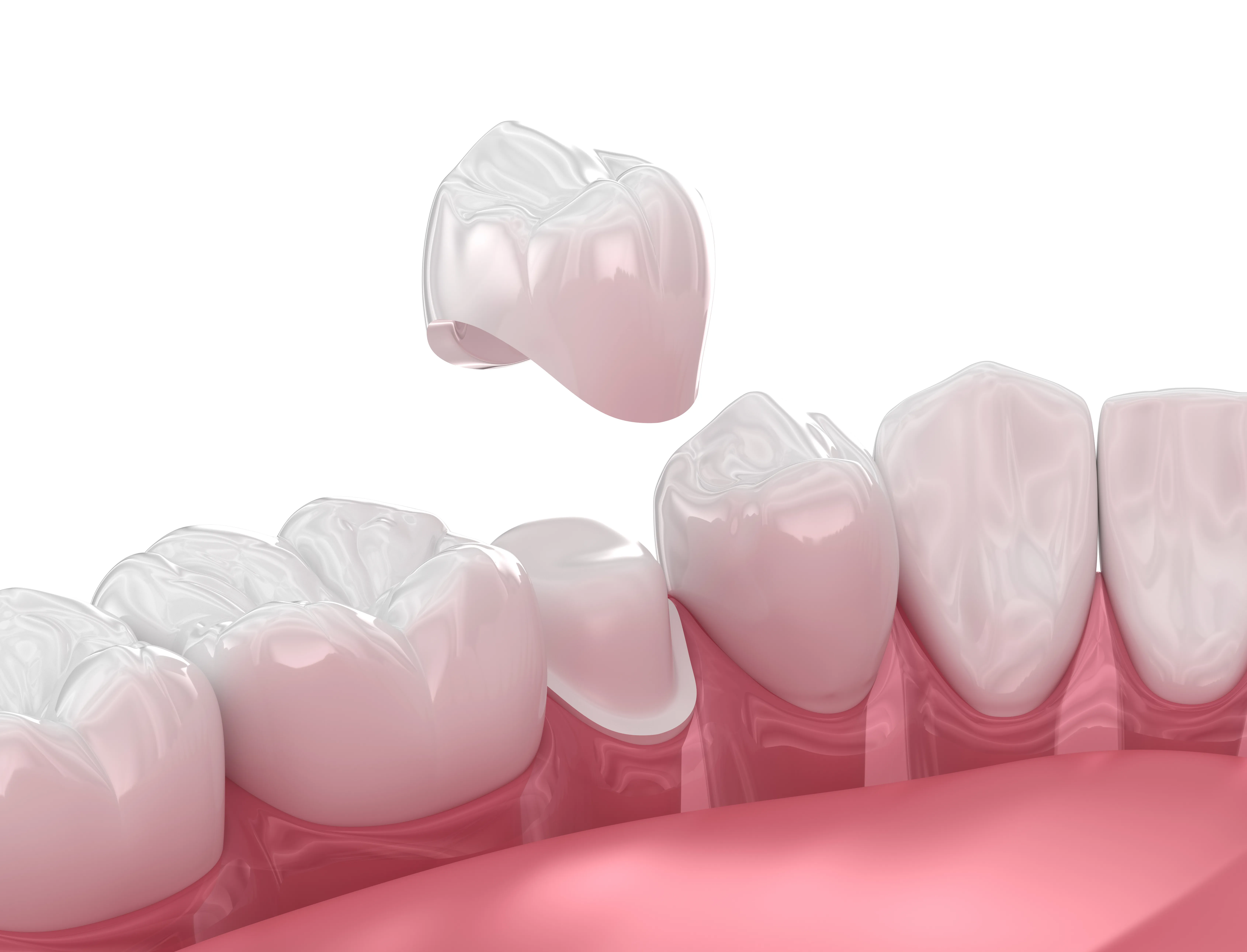 3D illustration of a dental crown being lowered onto a prepared lower back tooth