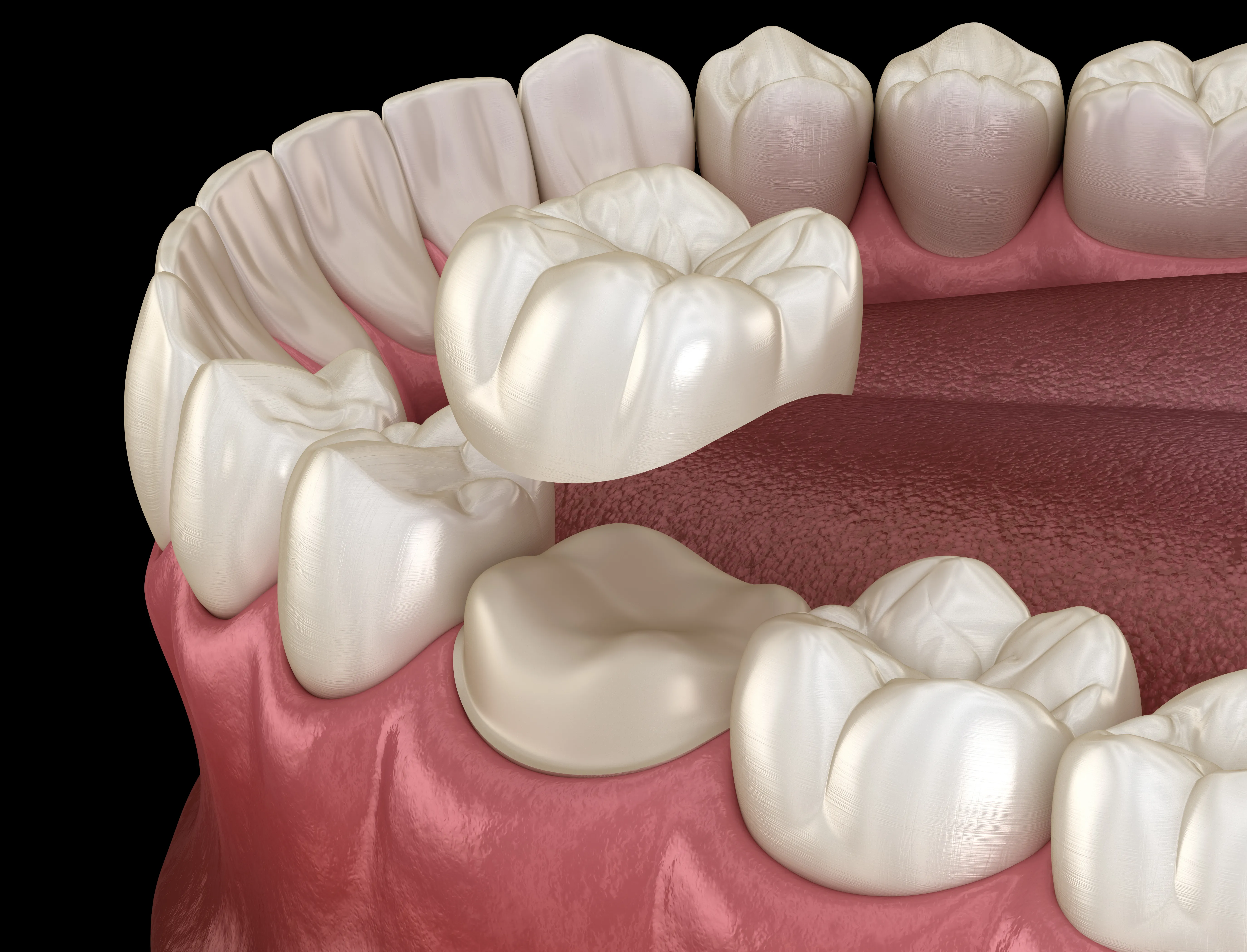 3D illustration of a lower dental arch with a tooth-colored restoration rebuilding the chewing surface of a back molar