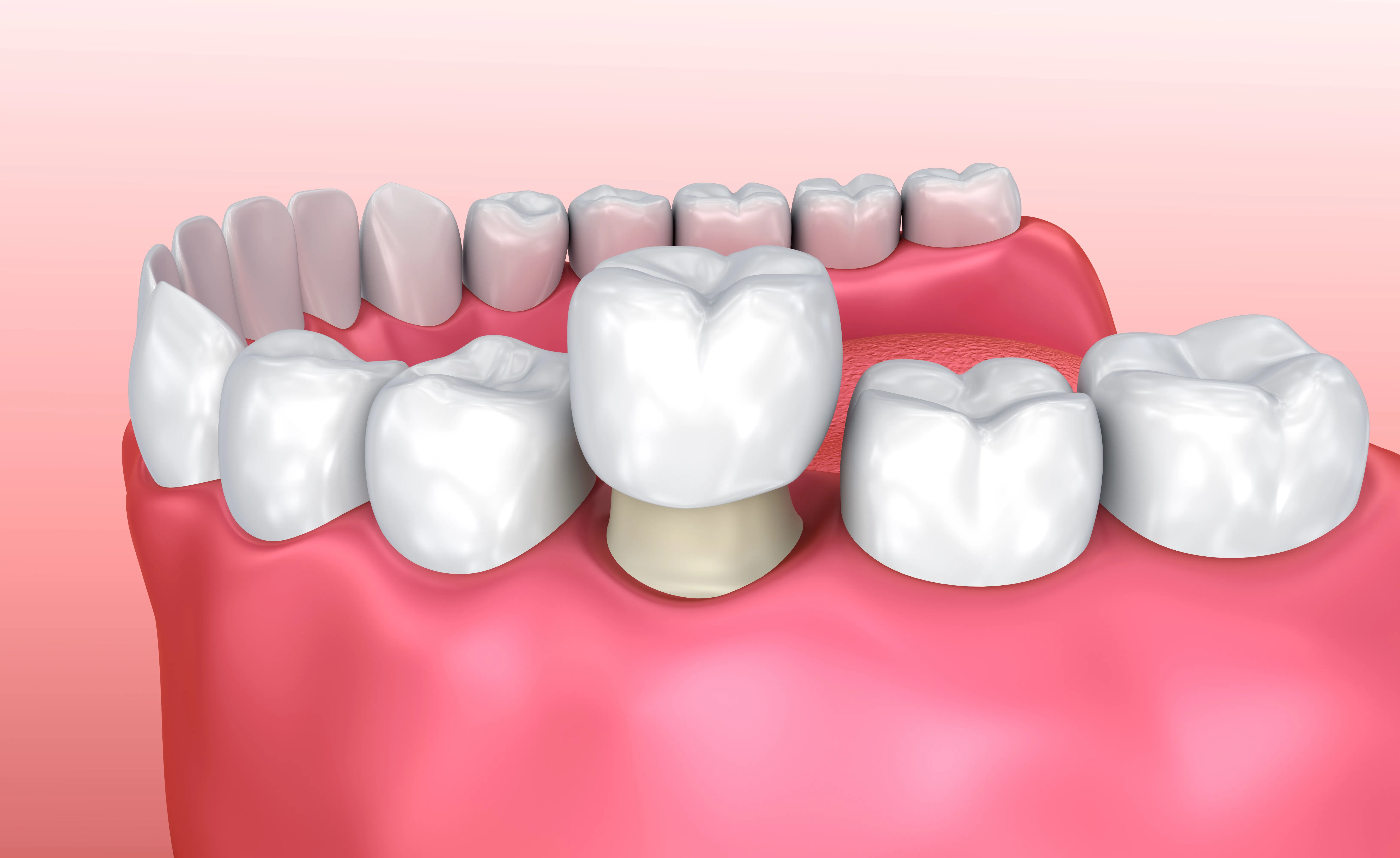 3D illustration of a dental crown being fitted onto a prepared lower tooth, with faint outlines of the natural teeth behind it
