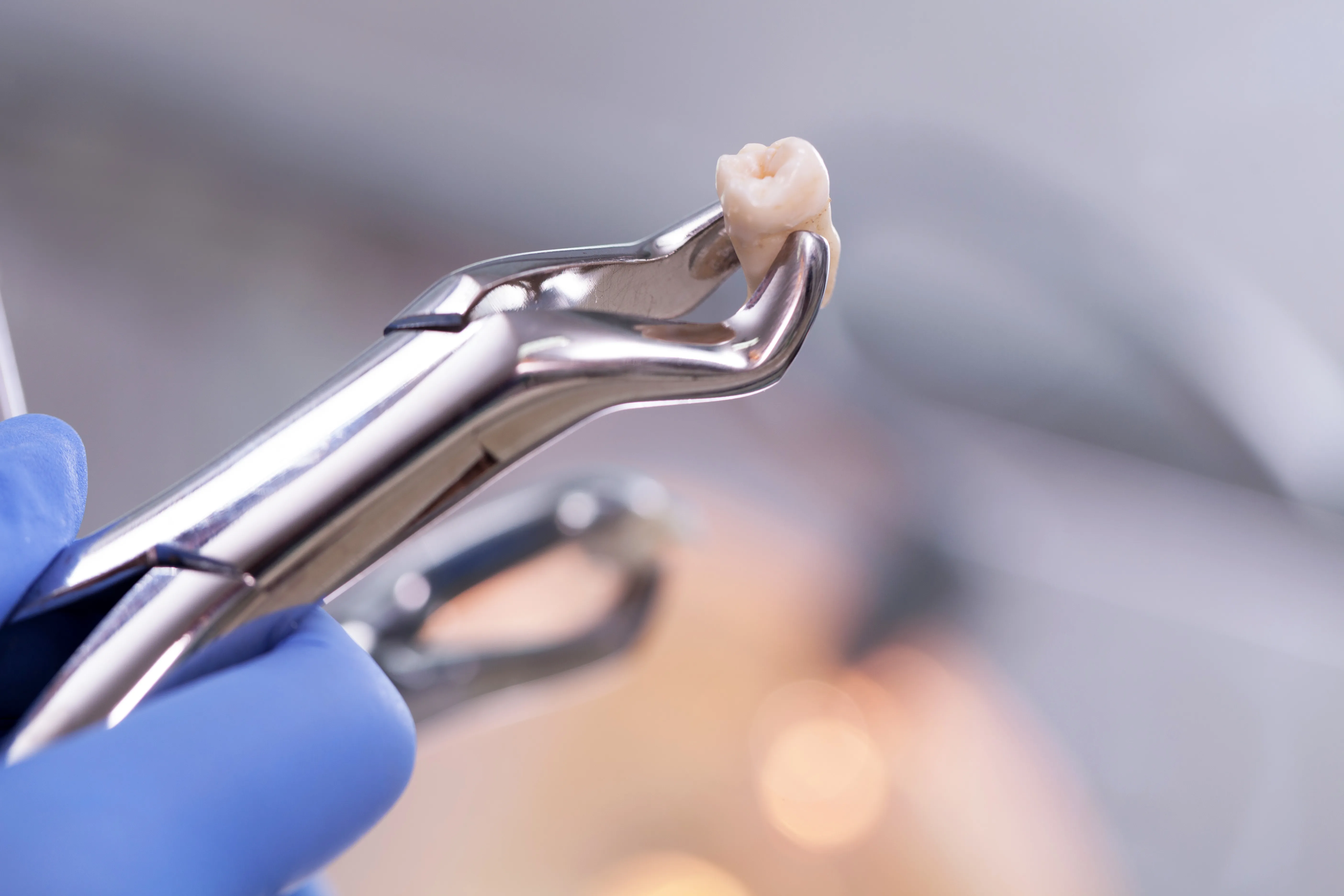 An extracted tooth held in dental forceps after a tooth extraction