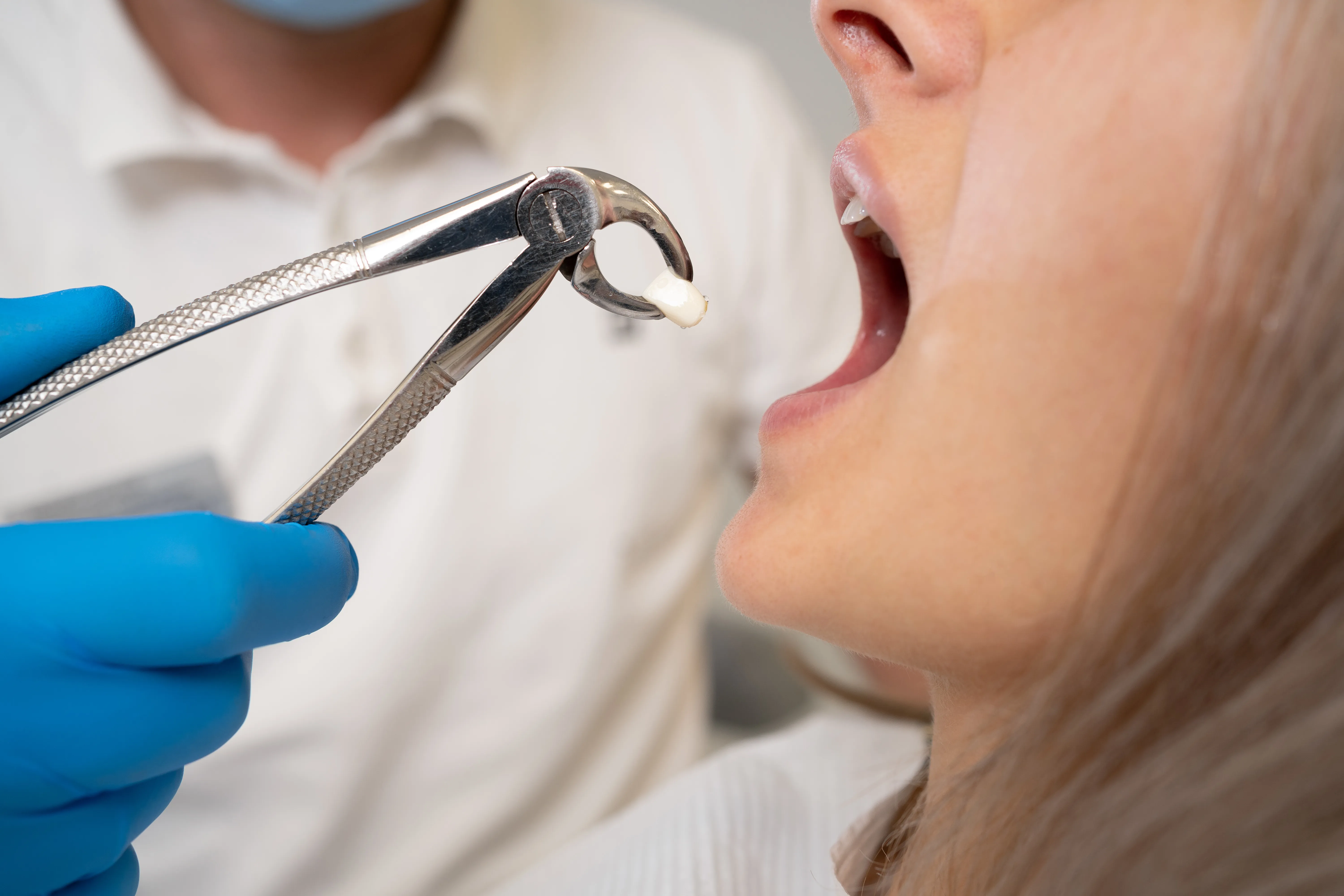 Dentist holding an extracted tooth in forceps beside a patient's open mouth
