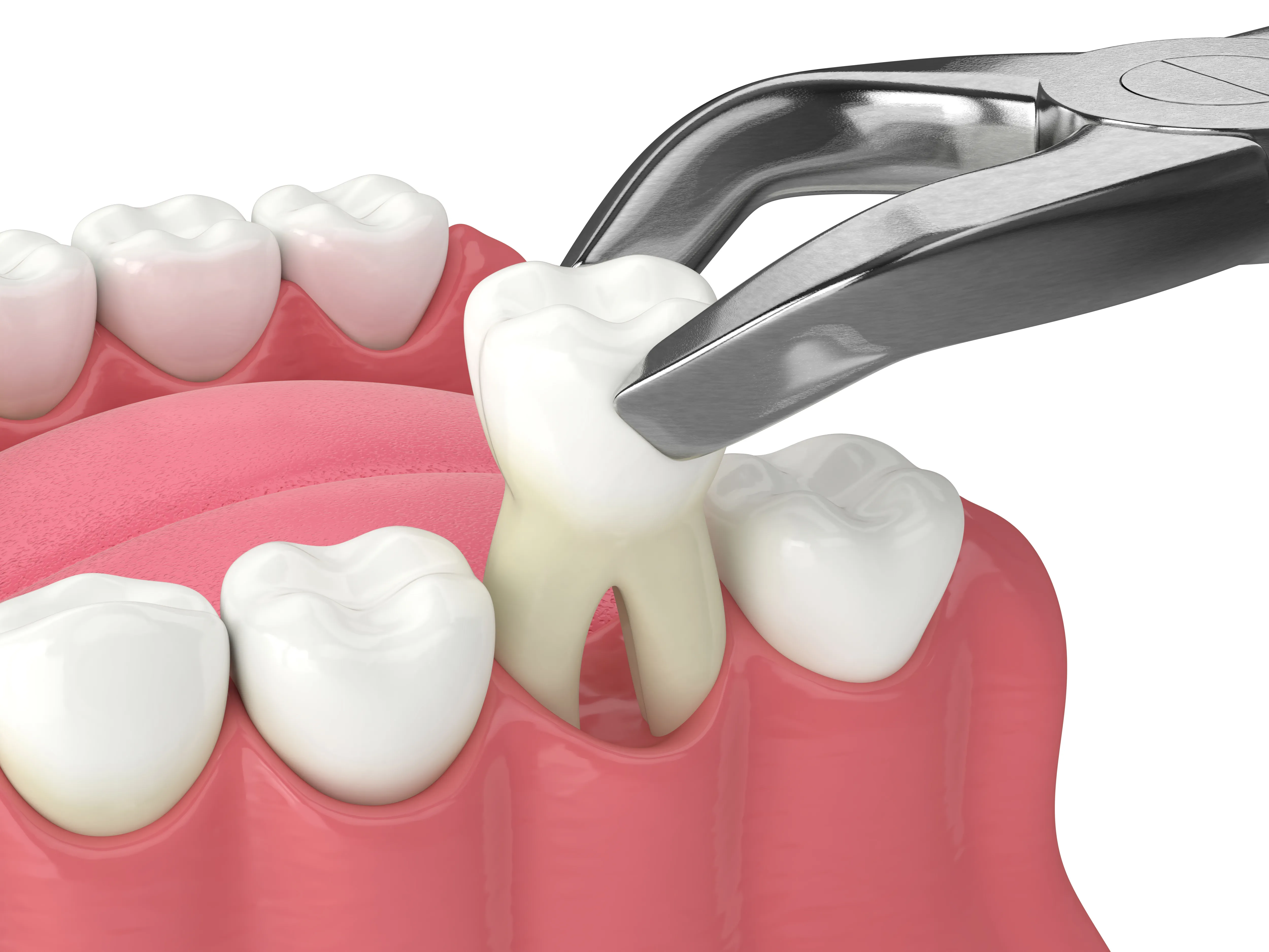 3D illustration of forceps lifting a tooth out of the lower gum during an extraction