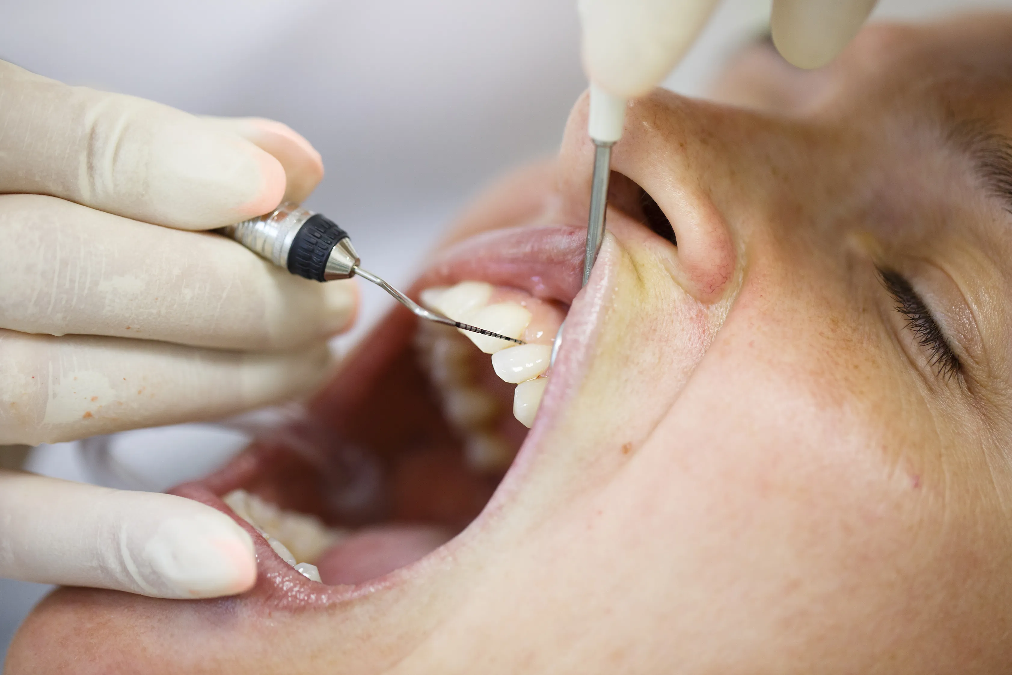 Close-up of scaling and root planing, with a dental instrument cleaning along a patient's gumline