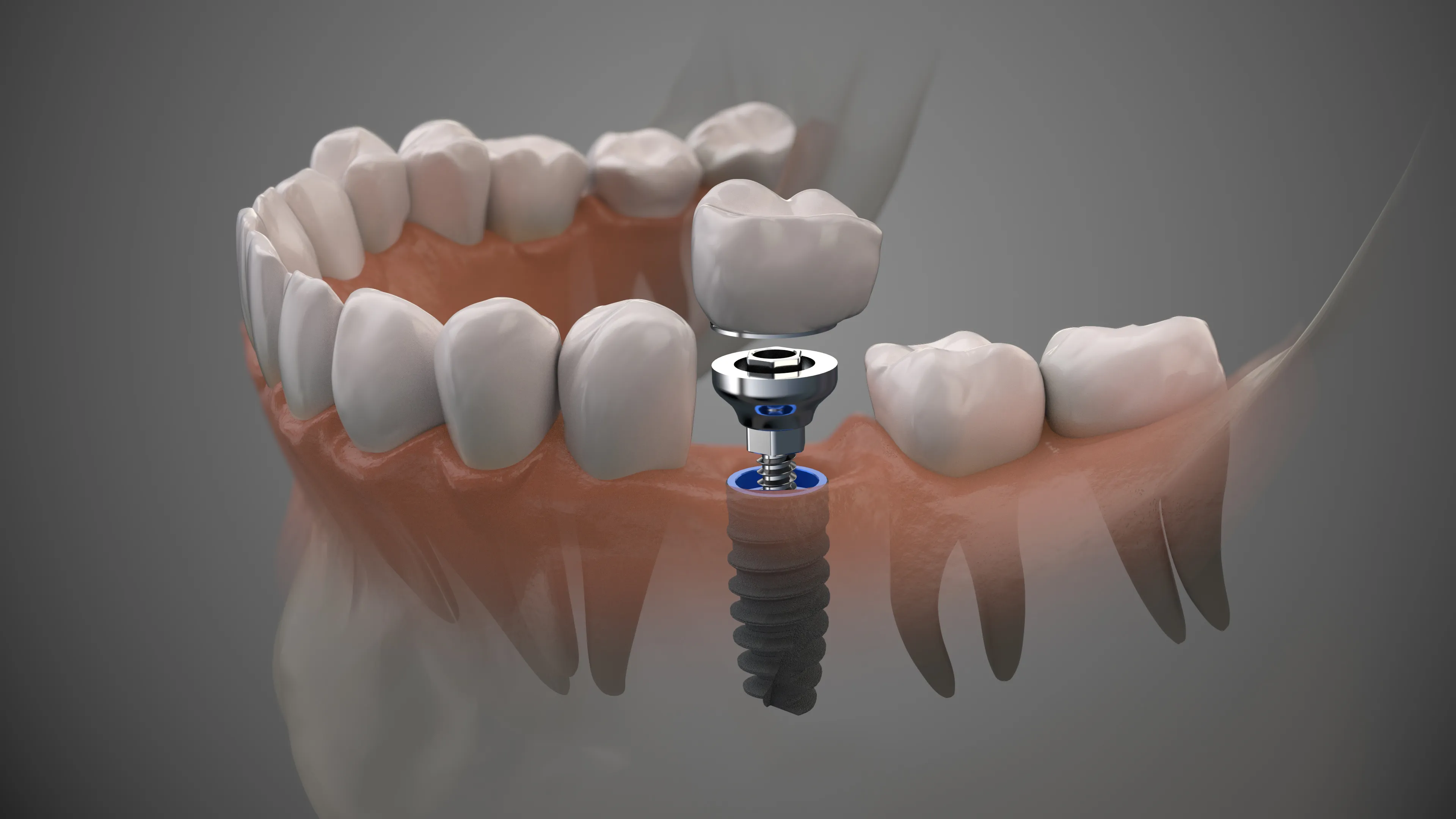 3D illustration of a single dental implant with a crown placed in the jaw